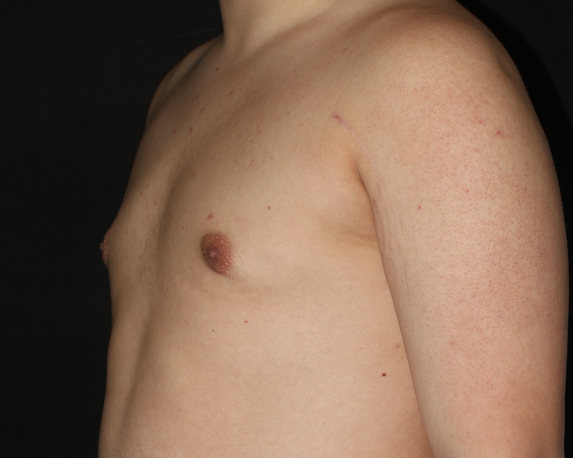 Male Breast Reduction - Before & After - Dr. Placik