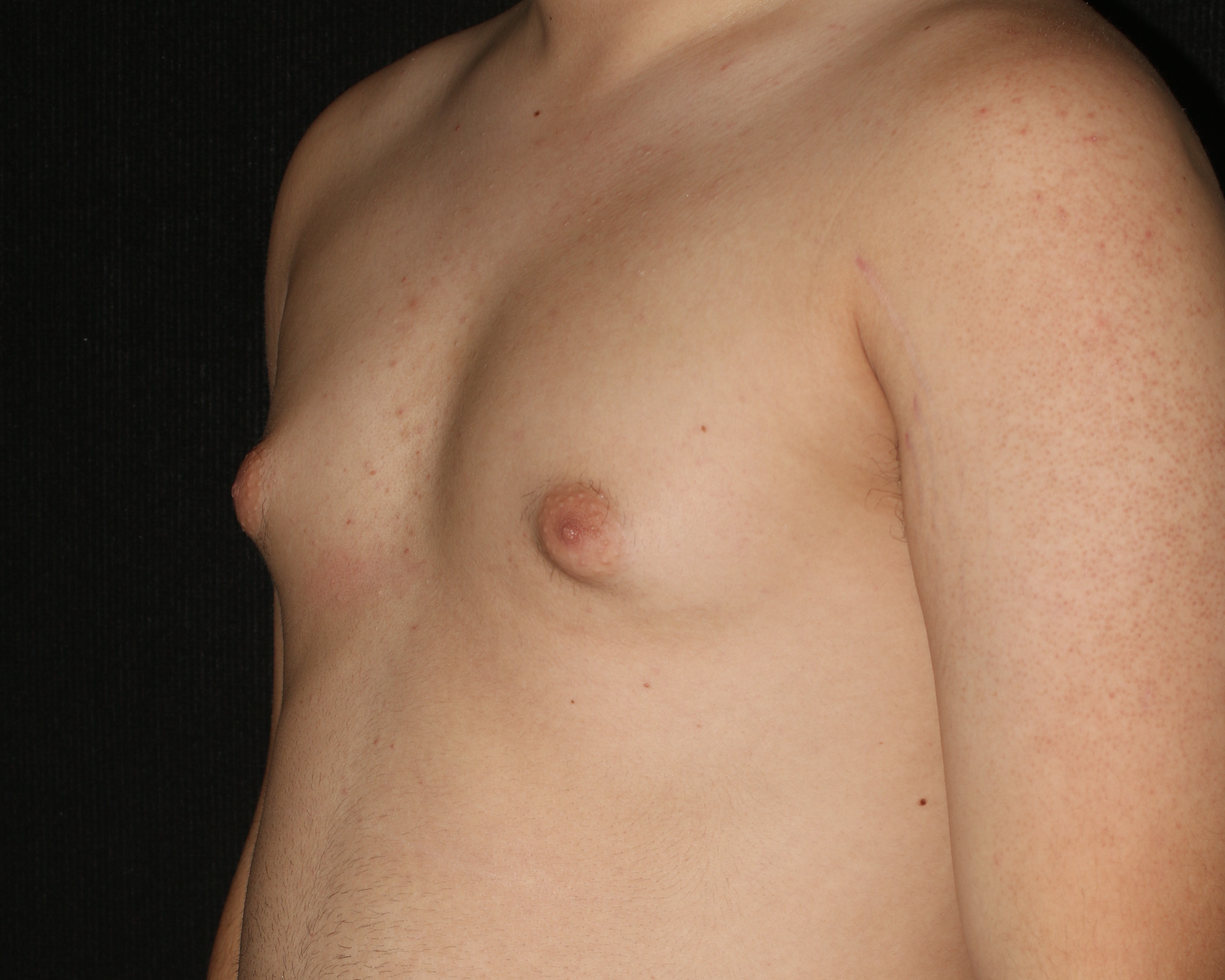 Male Breast Reduction - Before & After - Dr. Placik