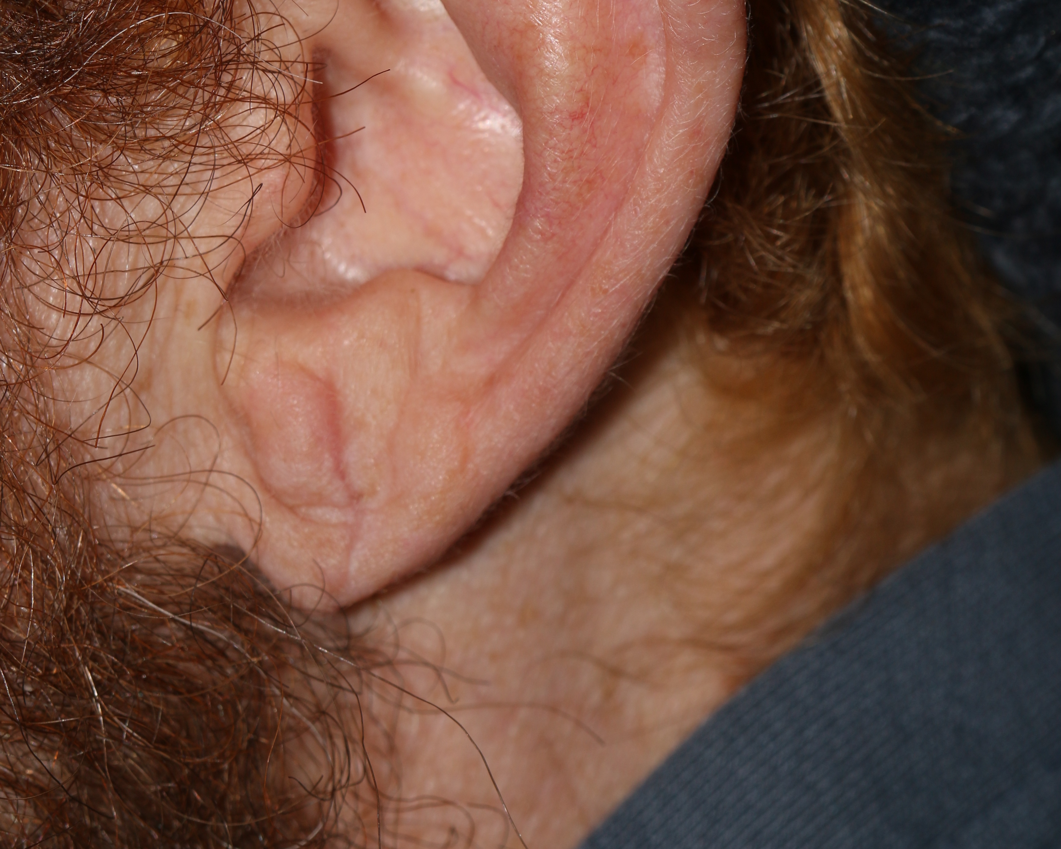 Earlobe Repair - Before & After - Dr. Placik