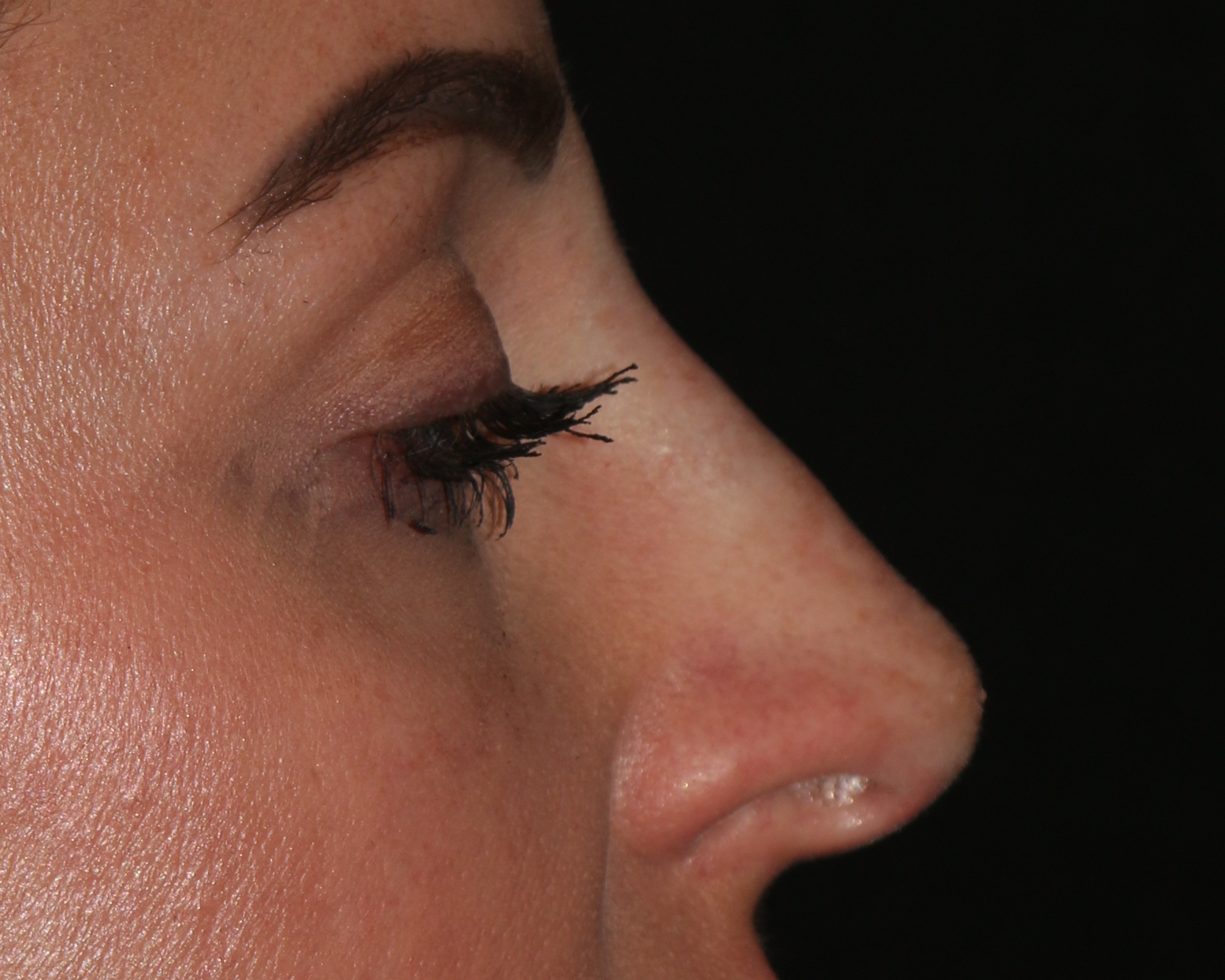 Non-Surgical Rhinoplasty - Before & After - Dr. Placik