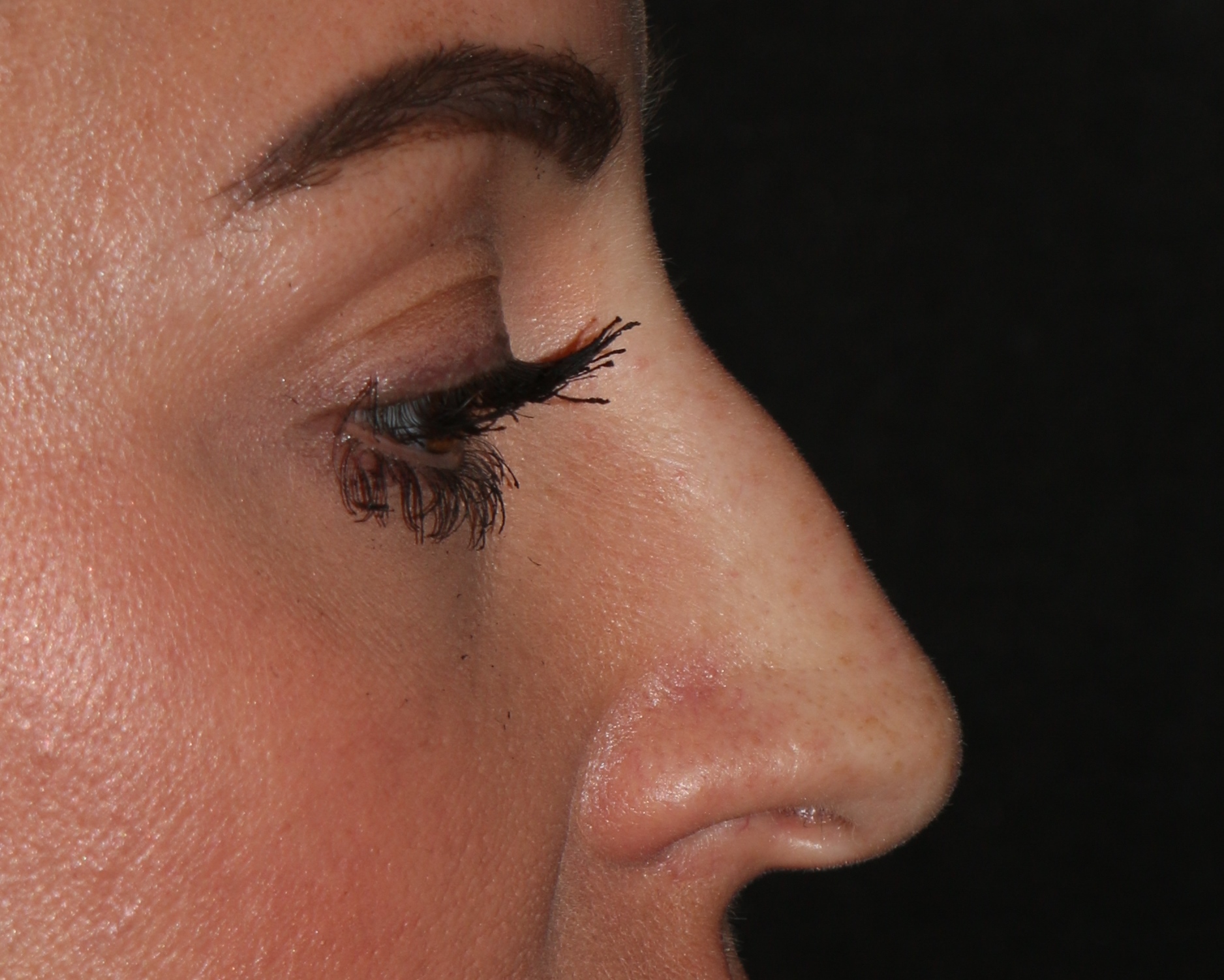 Non-Surgical Rhinoplasty - Before & After - Dr. Placik