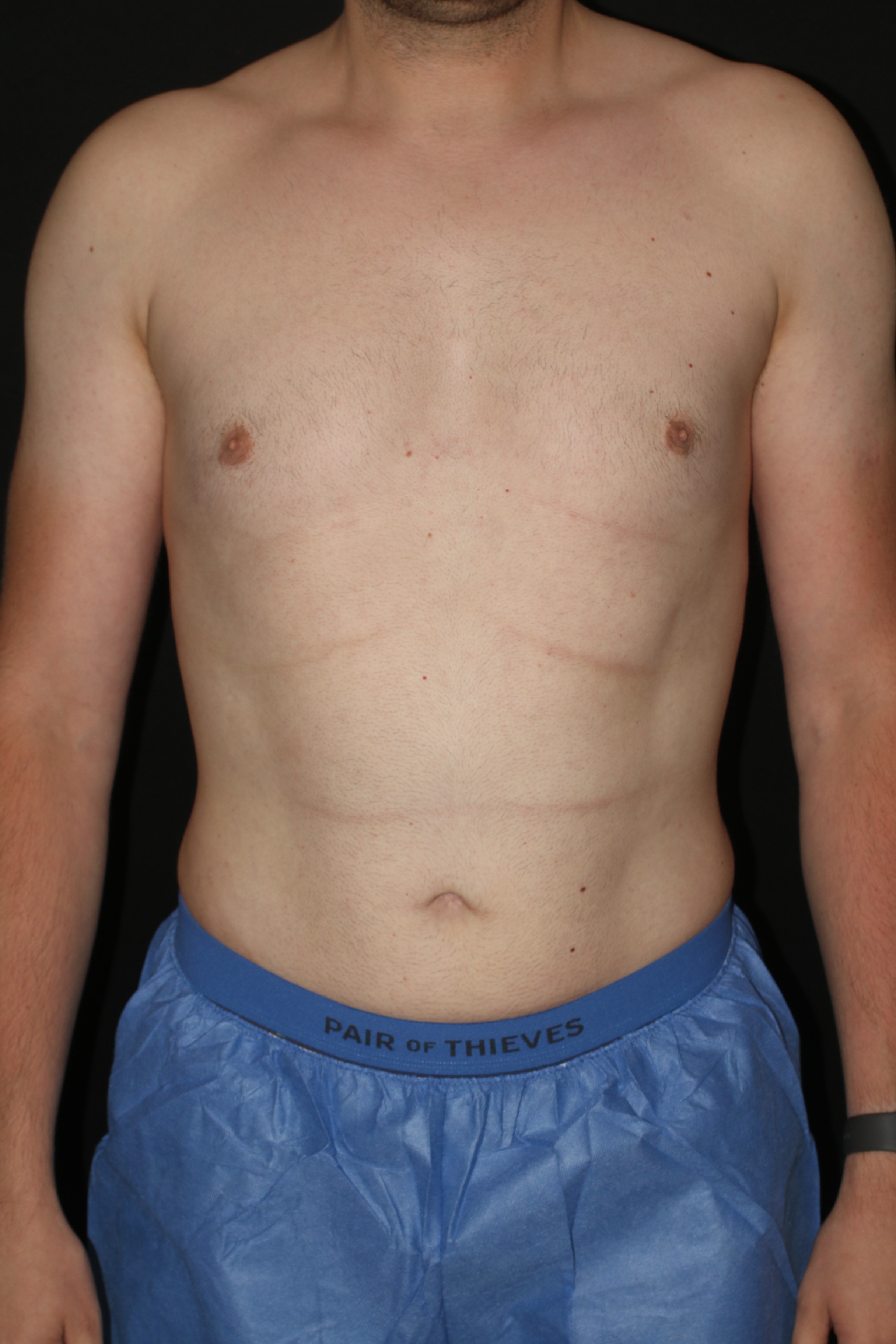 Male Liposuction - Before & After - Dr. Placik