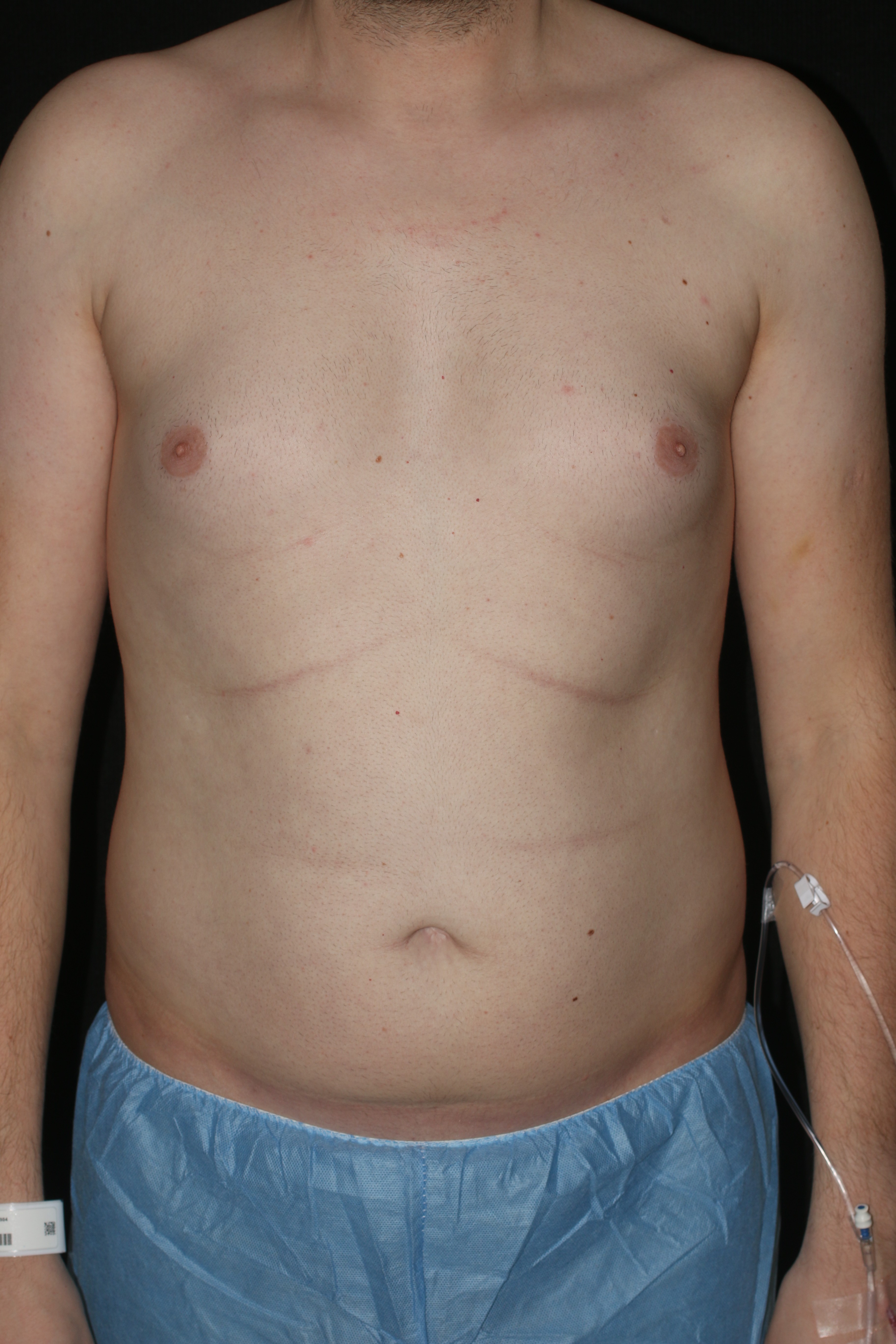 Male Liposuction - Before & After - Dr. Placik