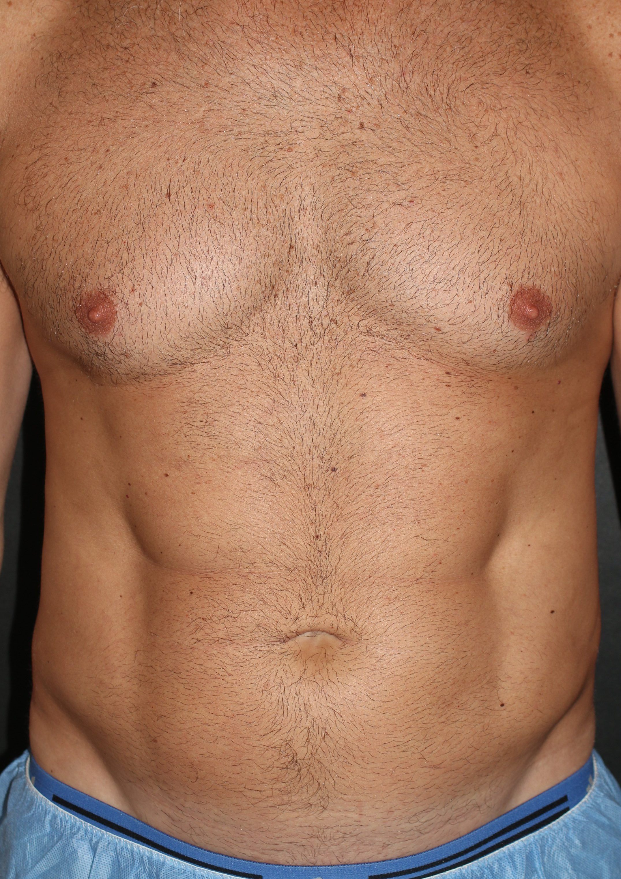 Liposuction - Before & After - Dr. Placik