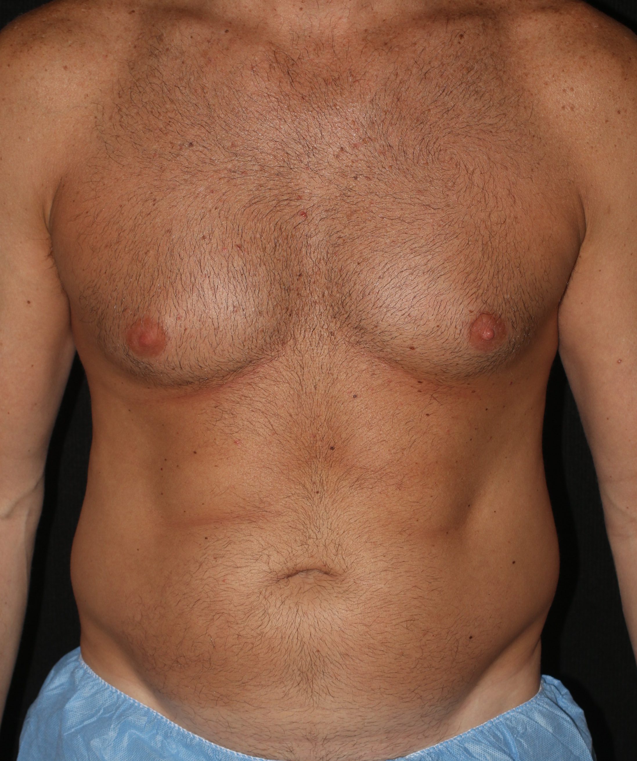 Liposuction - Before & After - Dr. Placik