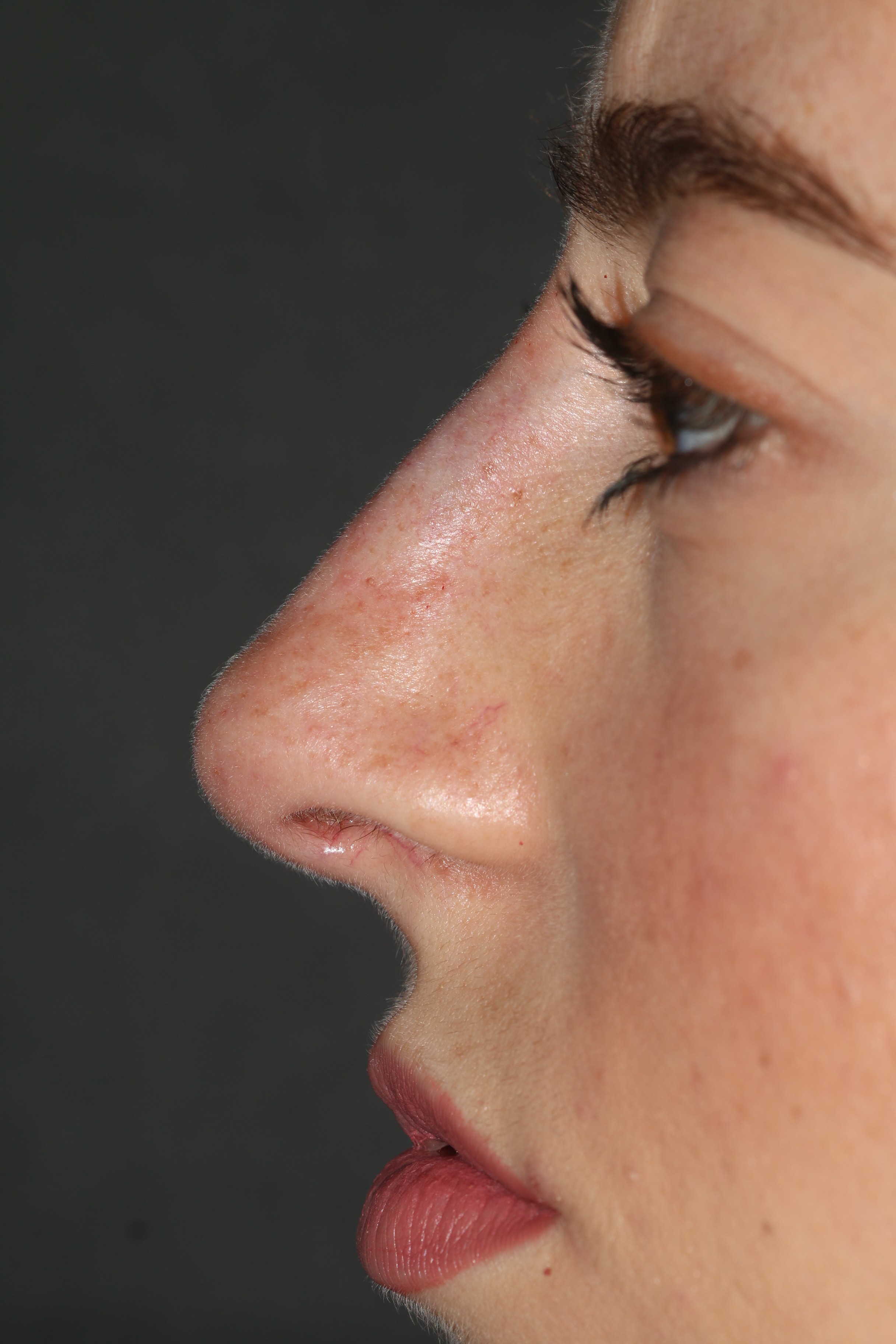 Non-Surgical Rhinoplasty - Before & After - Dr. Placik