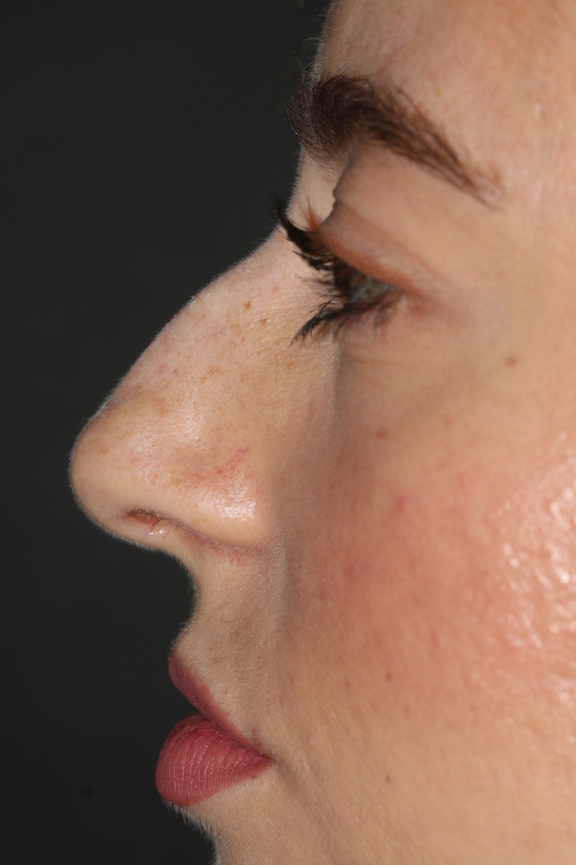 Non-Surgical Rhinoplasty - Before & After - Dr. Placik