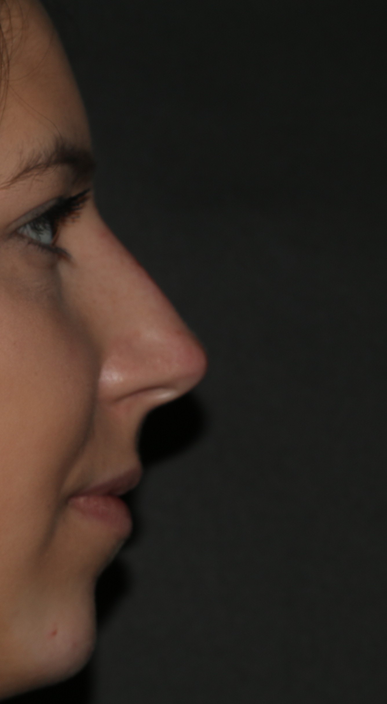 Non-Surgical Rhinoplasty - Before & After - Dr. Placik