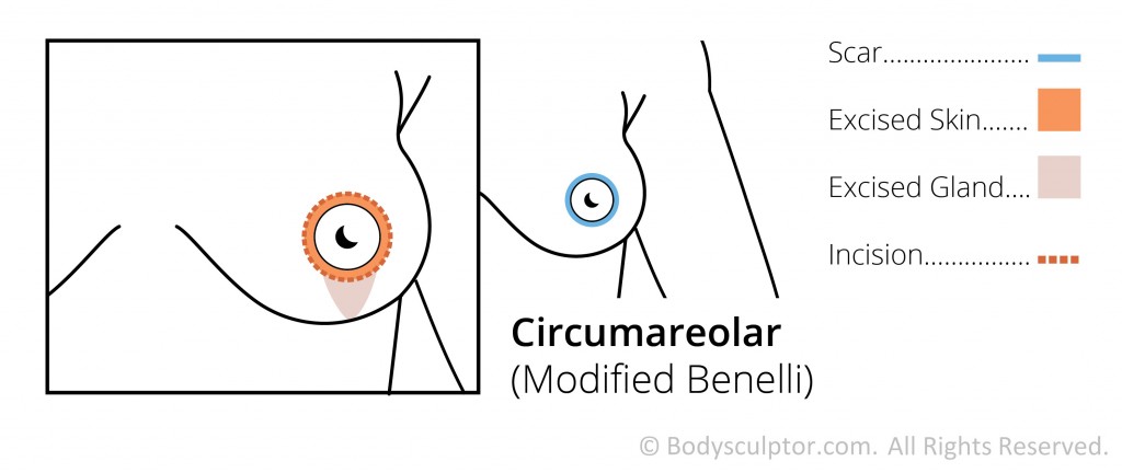 Breast Lift Scarring Diagram