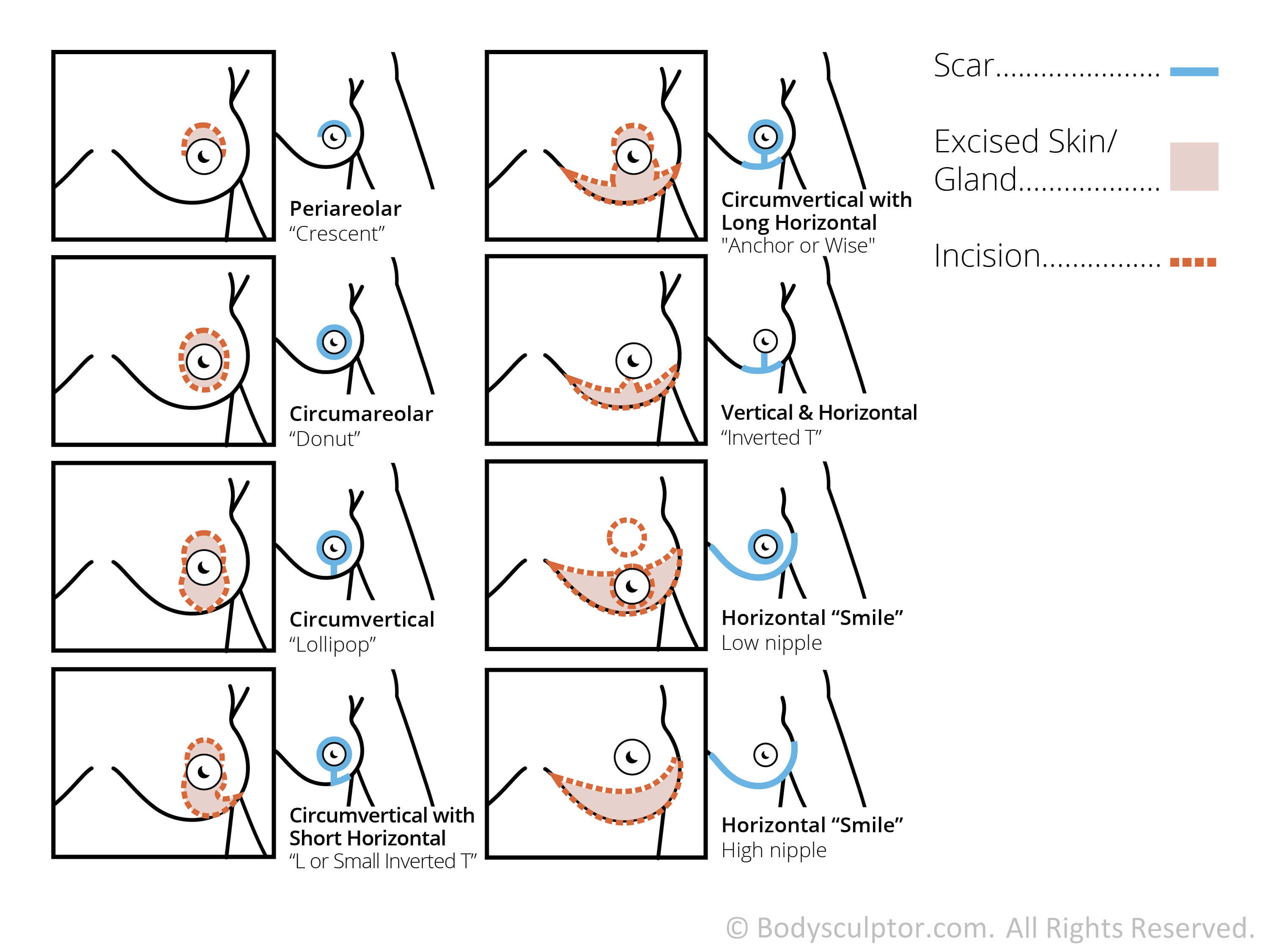 Before and After Breast Lift Diagram