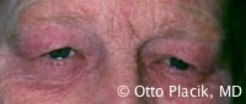 Male Blepharoplasty - Before & After - Dr. Placik