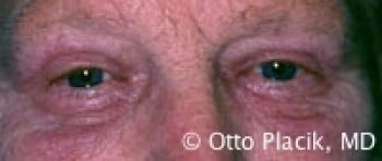 Male Blepharoplasty - Before & After - Dr. Placik