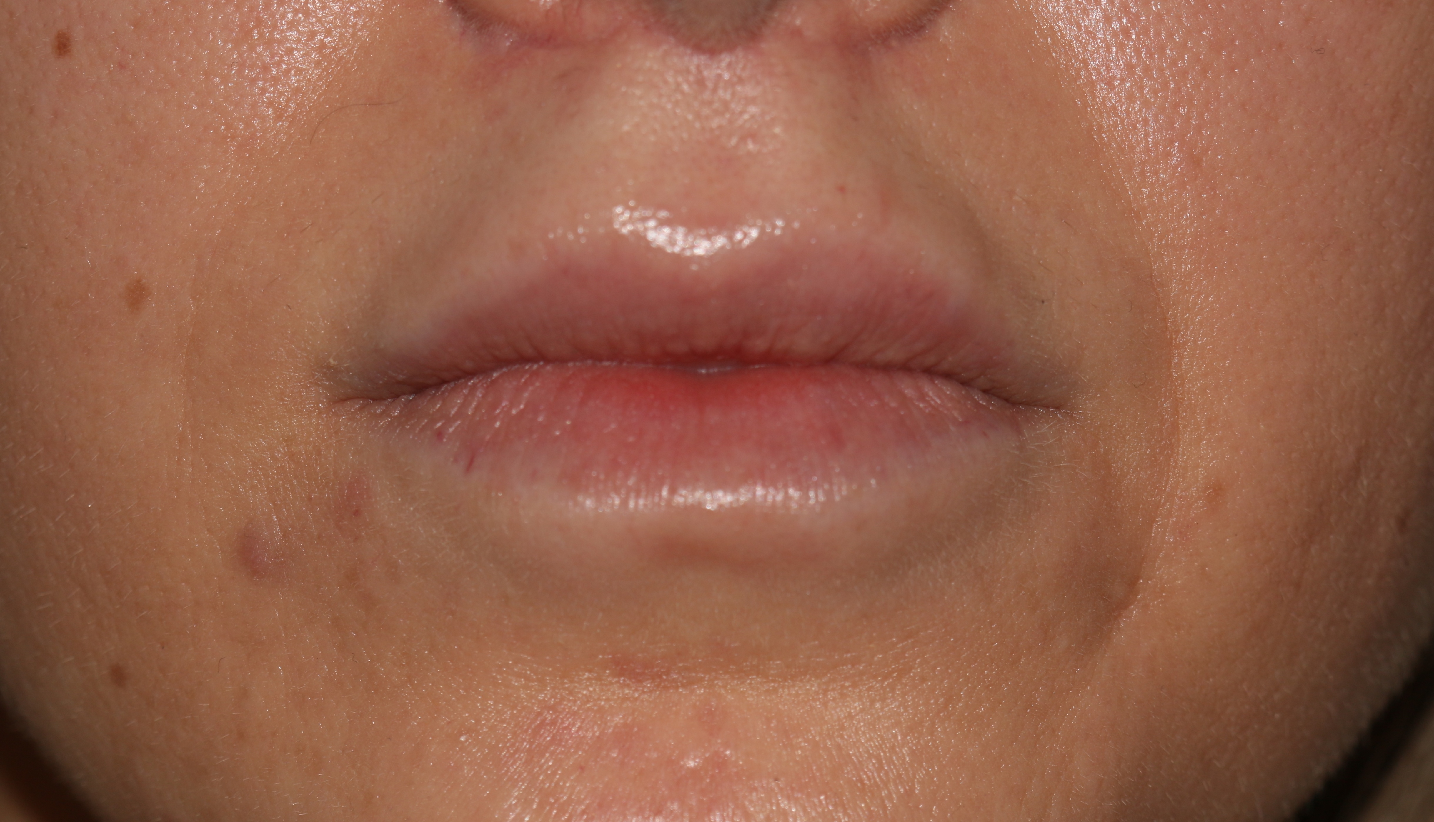 Lip Enhancement - Before & After - Dr. Placik