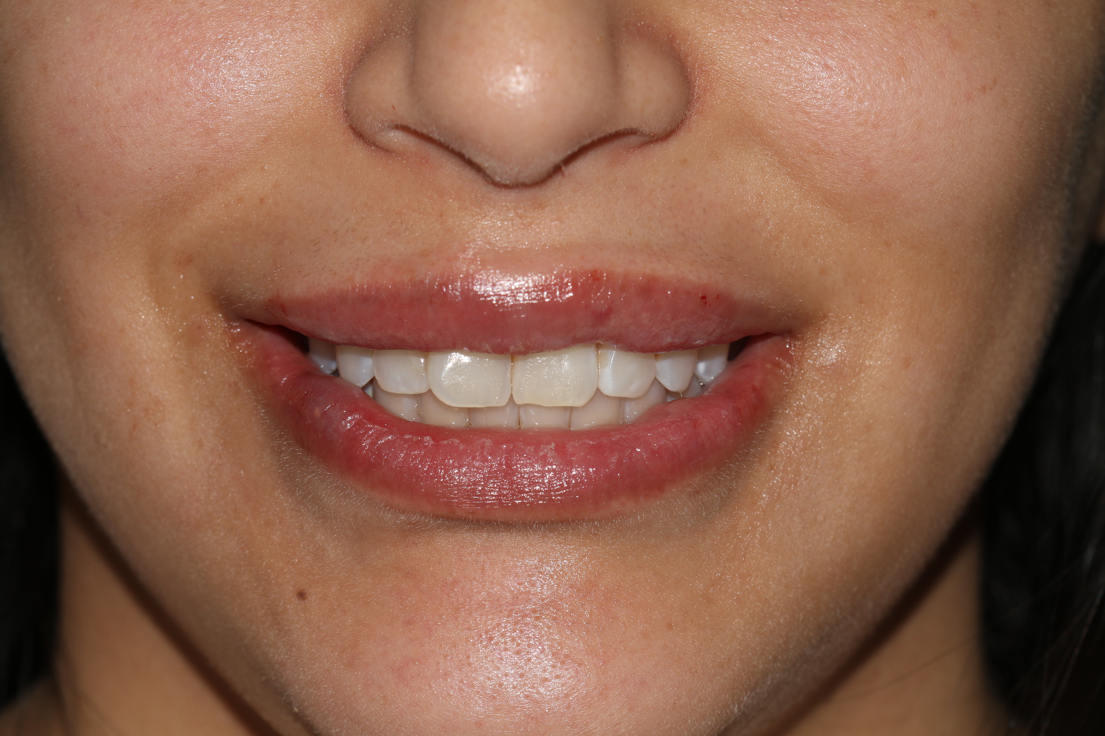 Lip Enhancement - Before & After - Dr. Placik