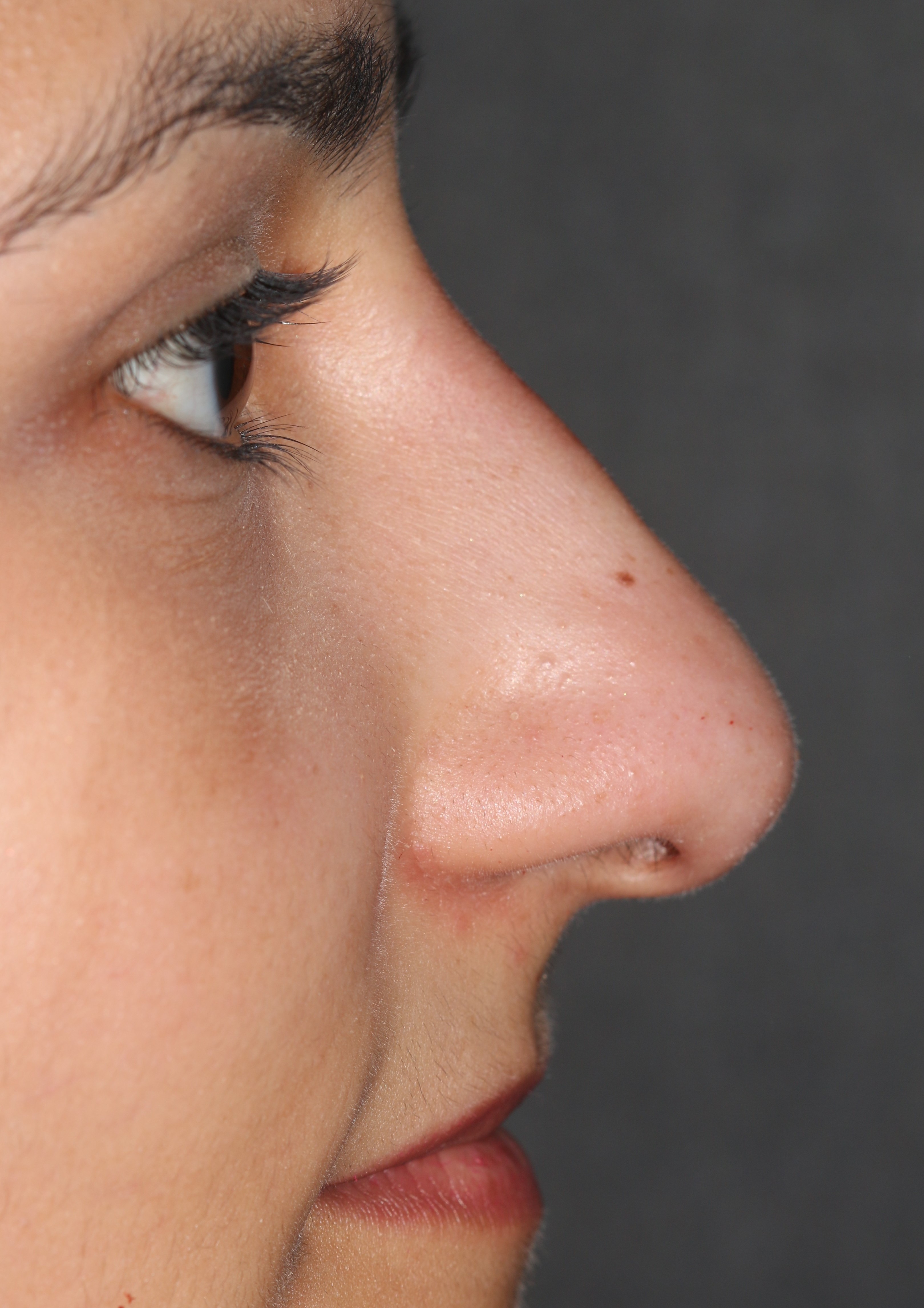 Non-Surgical Rhinoplasty - Before & After - Dr. Placik