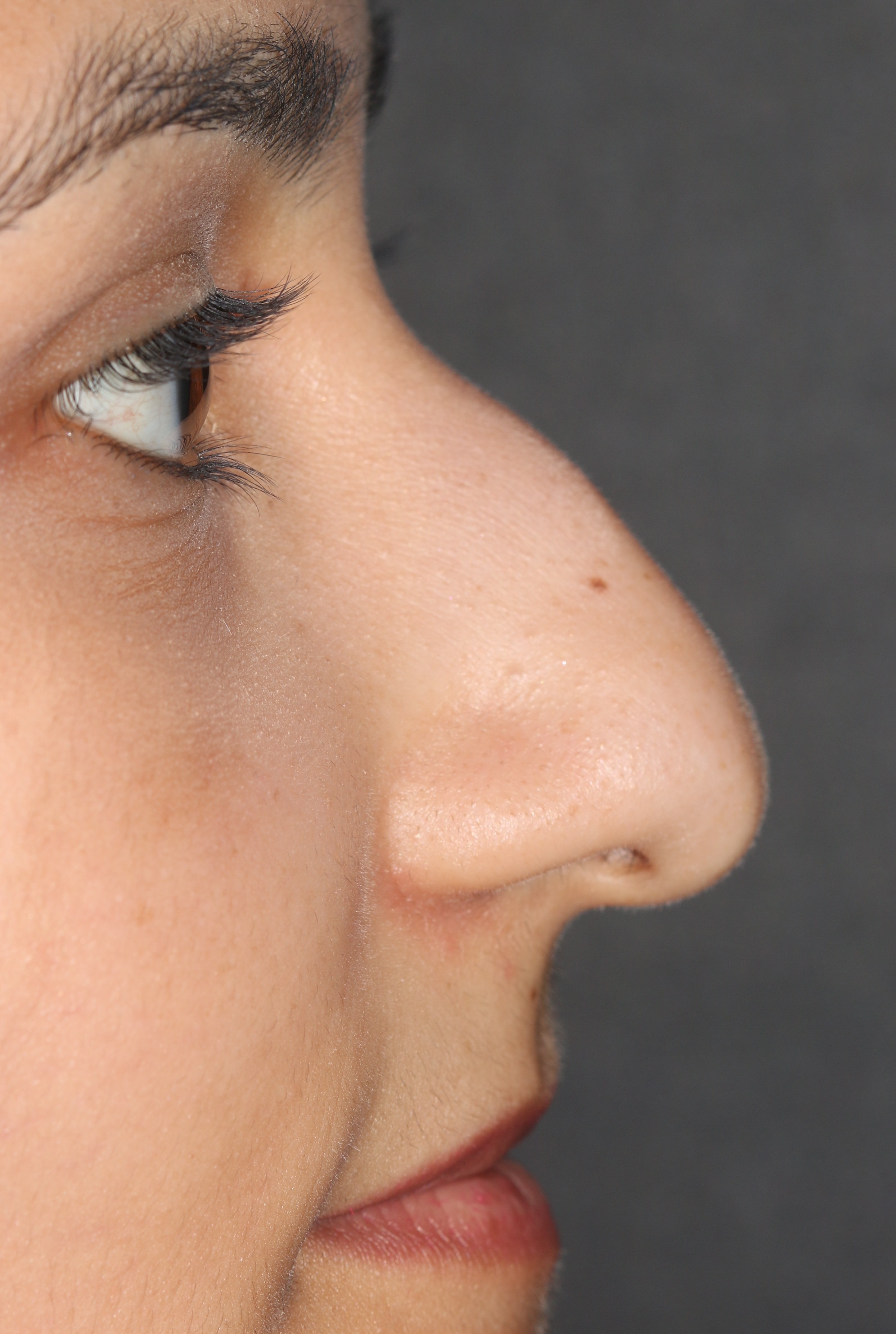 Non-Surgical Rhinoplasty - Before & After - Dr. Placik