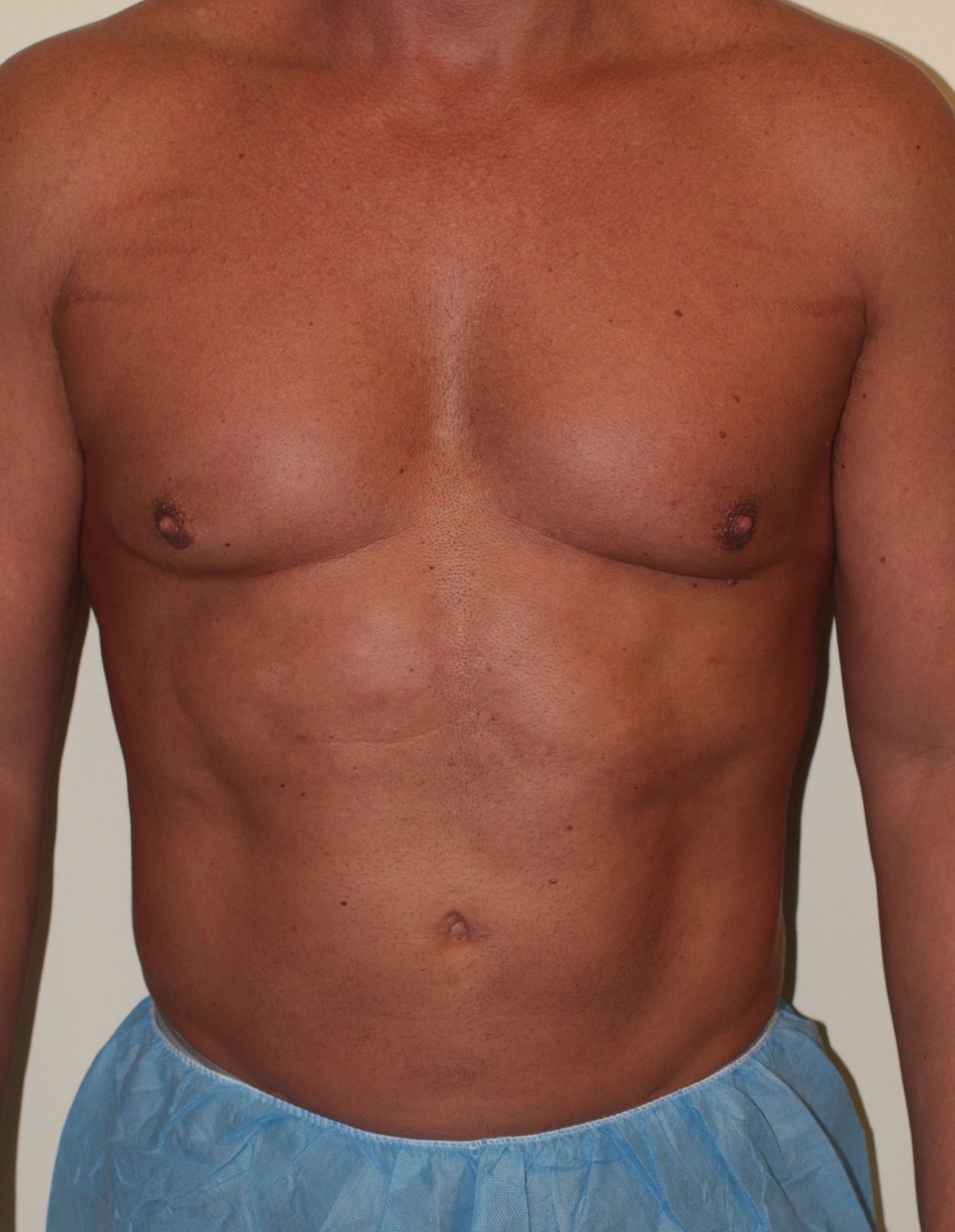 Male Liposuction - Before & After - Dr. Placik