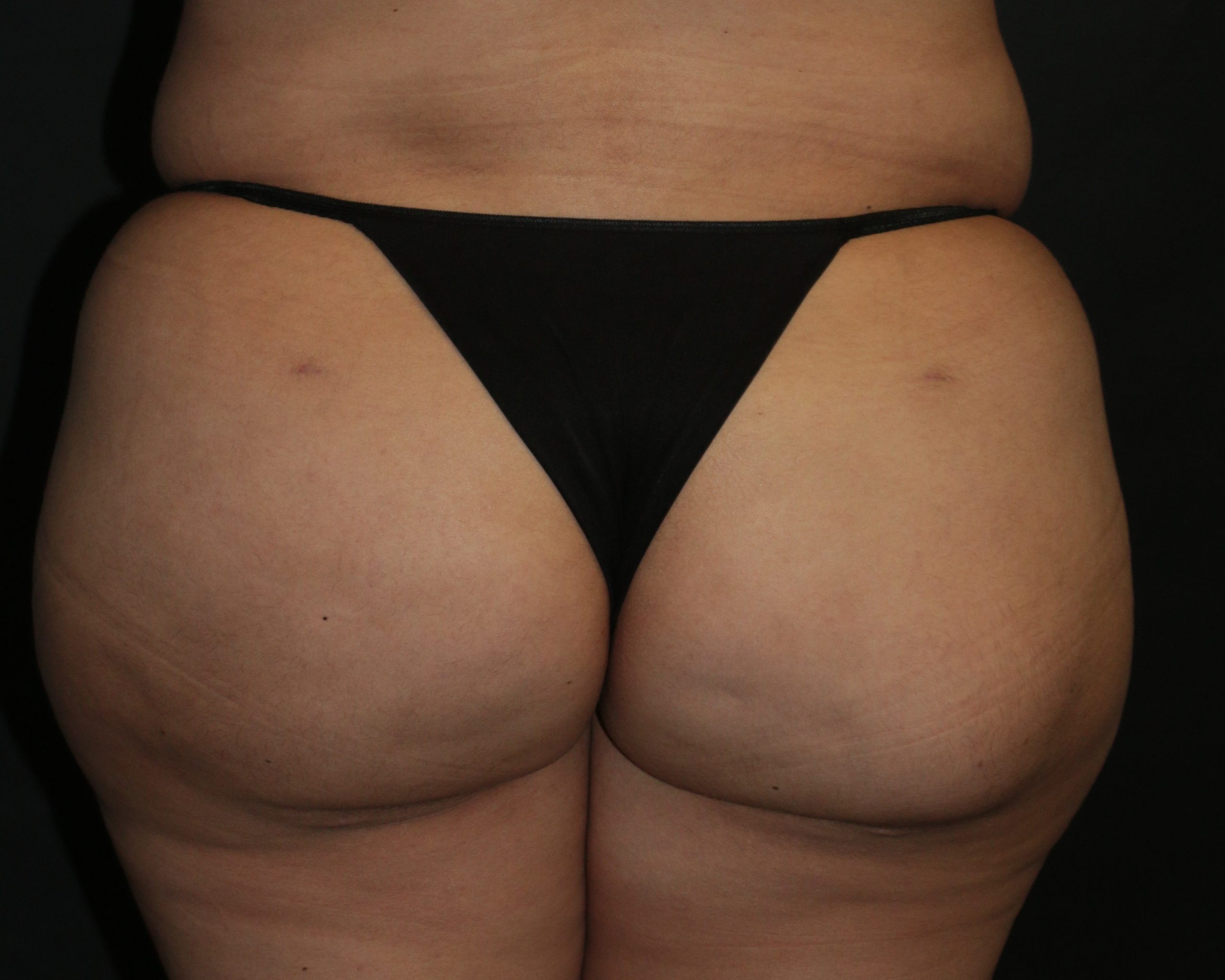 Butt Augmentation - Before & After - Dr. Placik