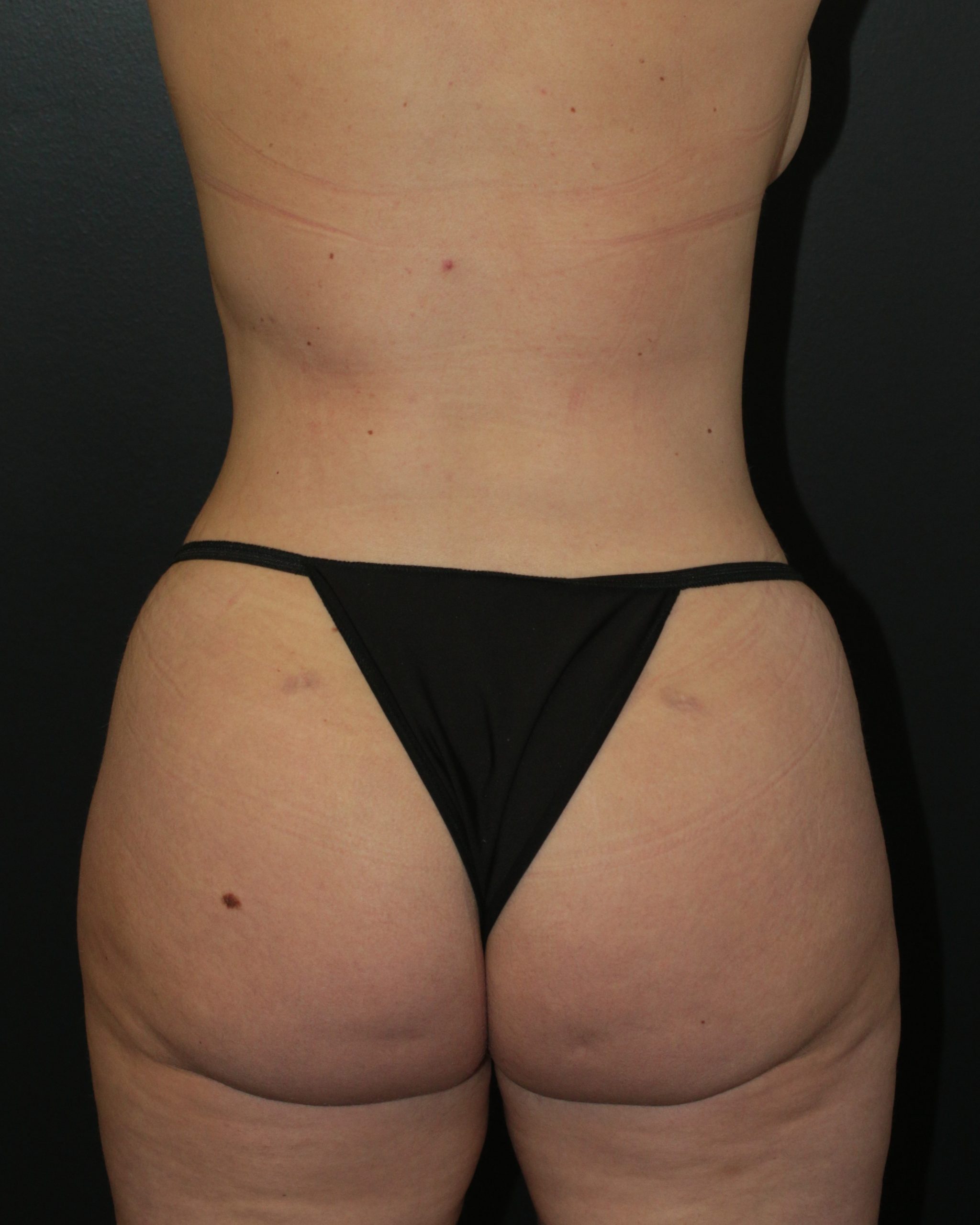 Butt Augmentation - Before & After - Dr. Placik