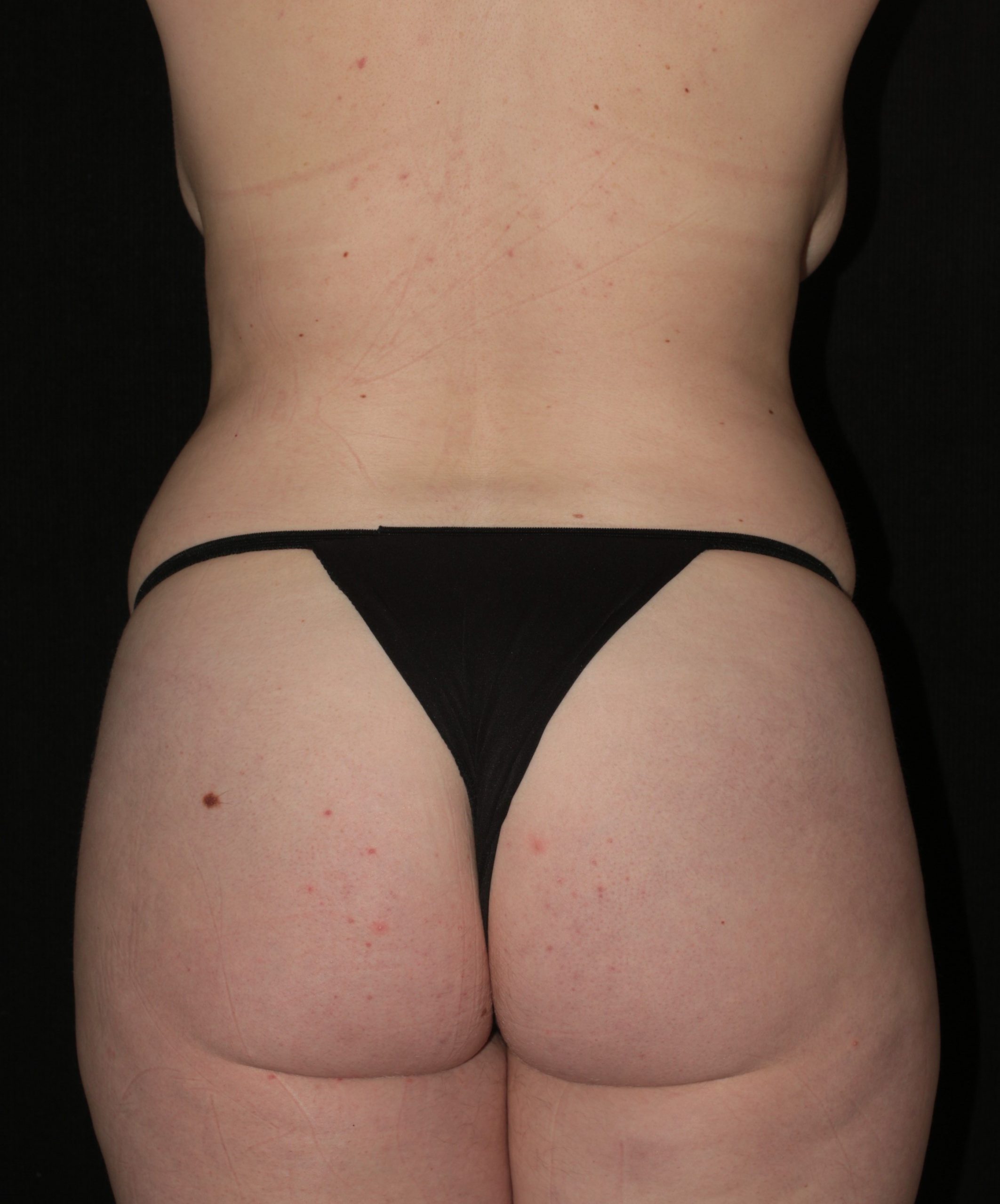 Butt Augmentation - Before & After - Dr. Placik