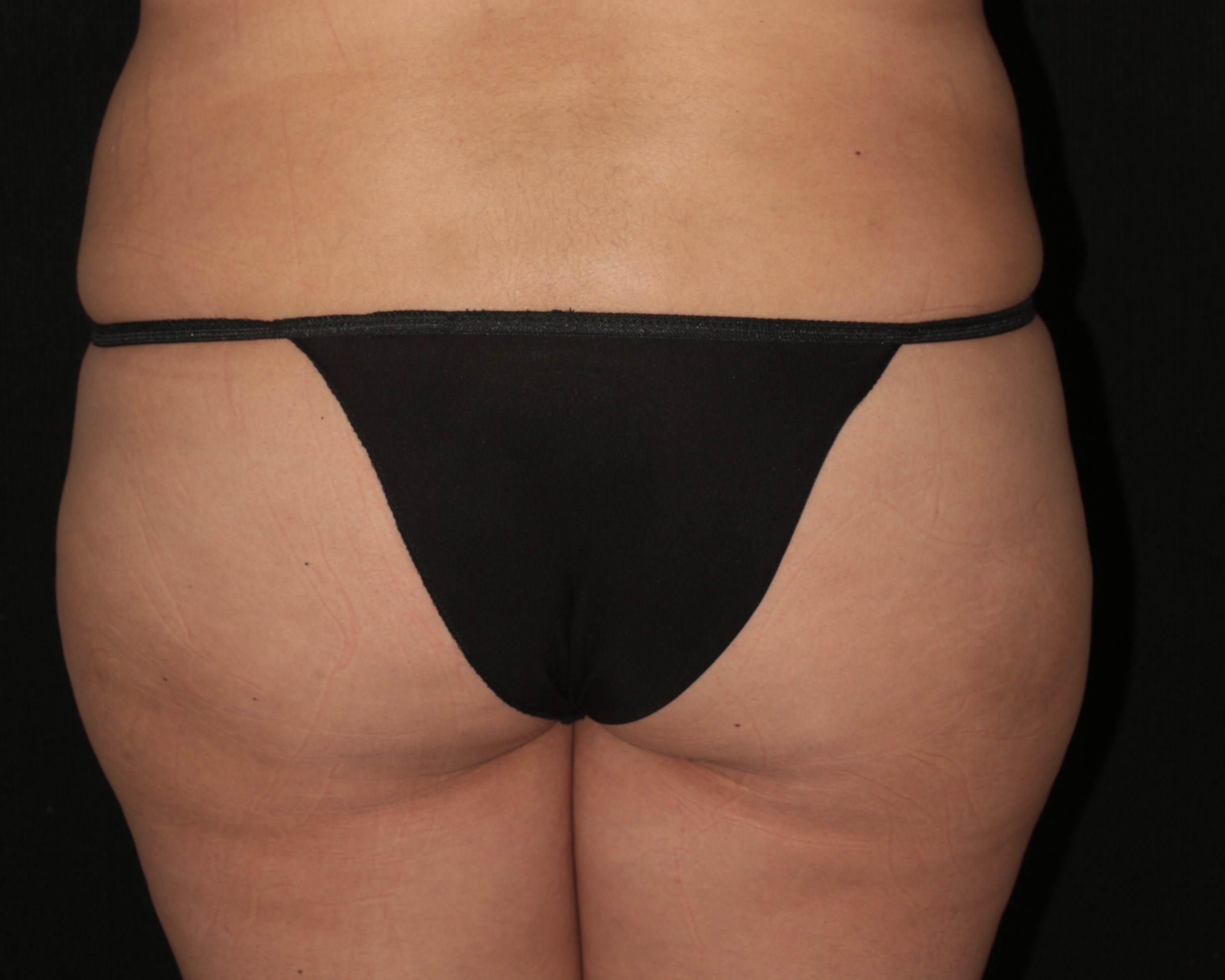 Butt Augmentation - Before & After - Dr. Placik