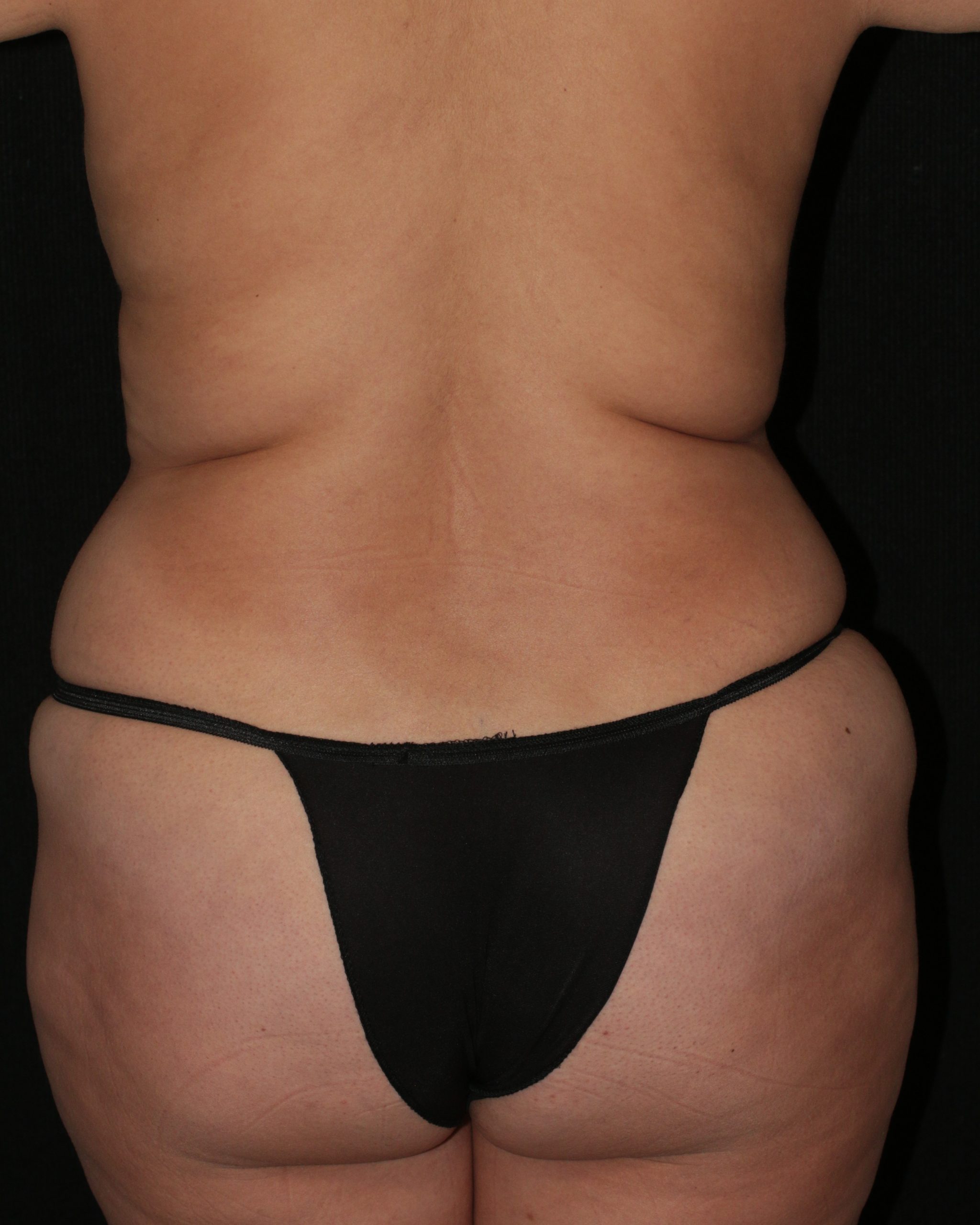 Butt Augmentation - Before & After - Dr. Placik