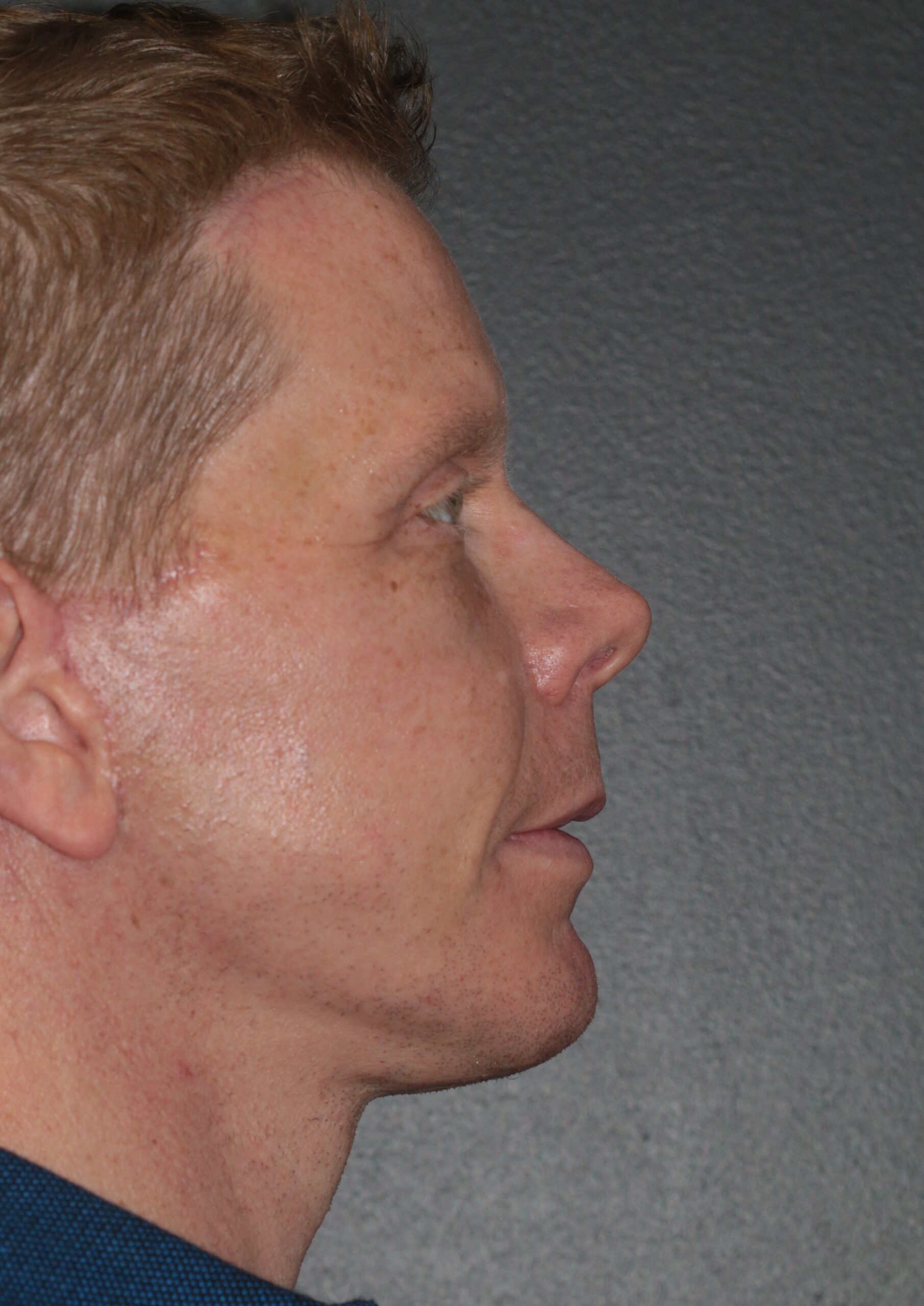 Face Lift - Before & After - Dr. Placik