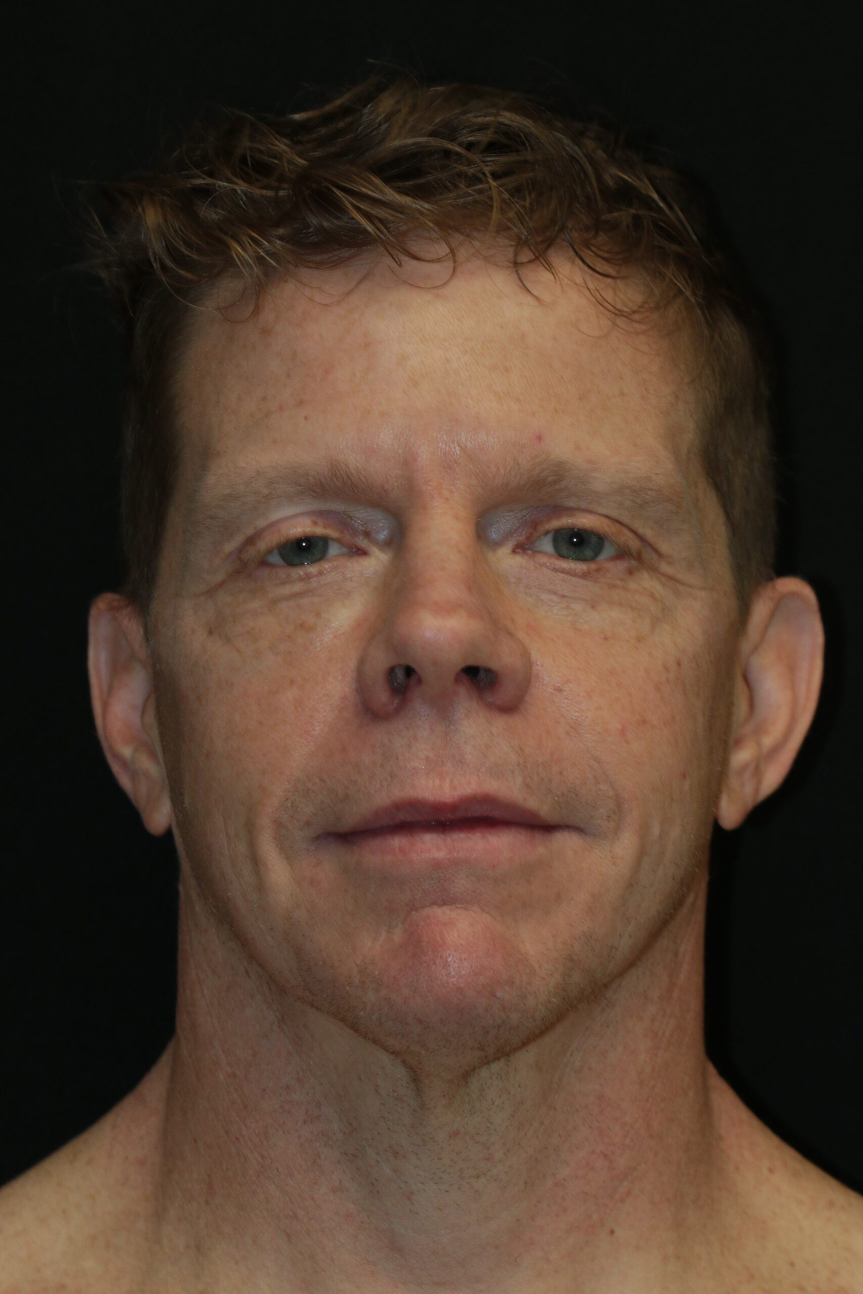 Facelift with Liposuction to Neck & Jowls, Forehead Lift, Bilateral Upper Lid Blepharoplasty, Fat Transfer to Various Facial Areas