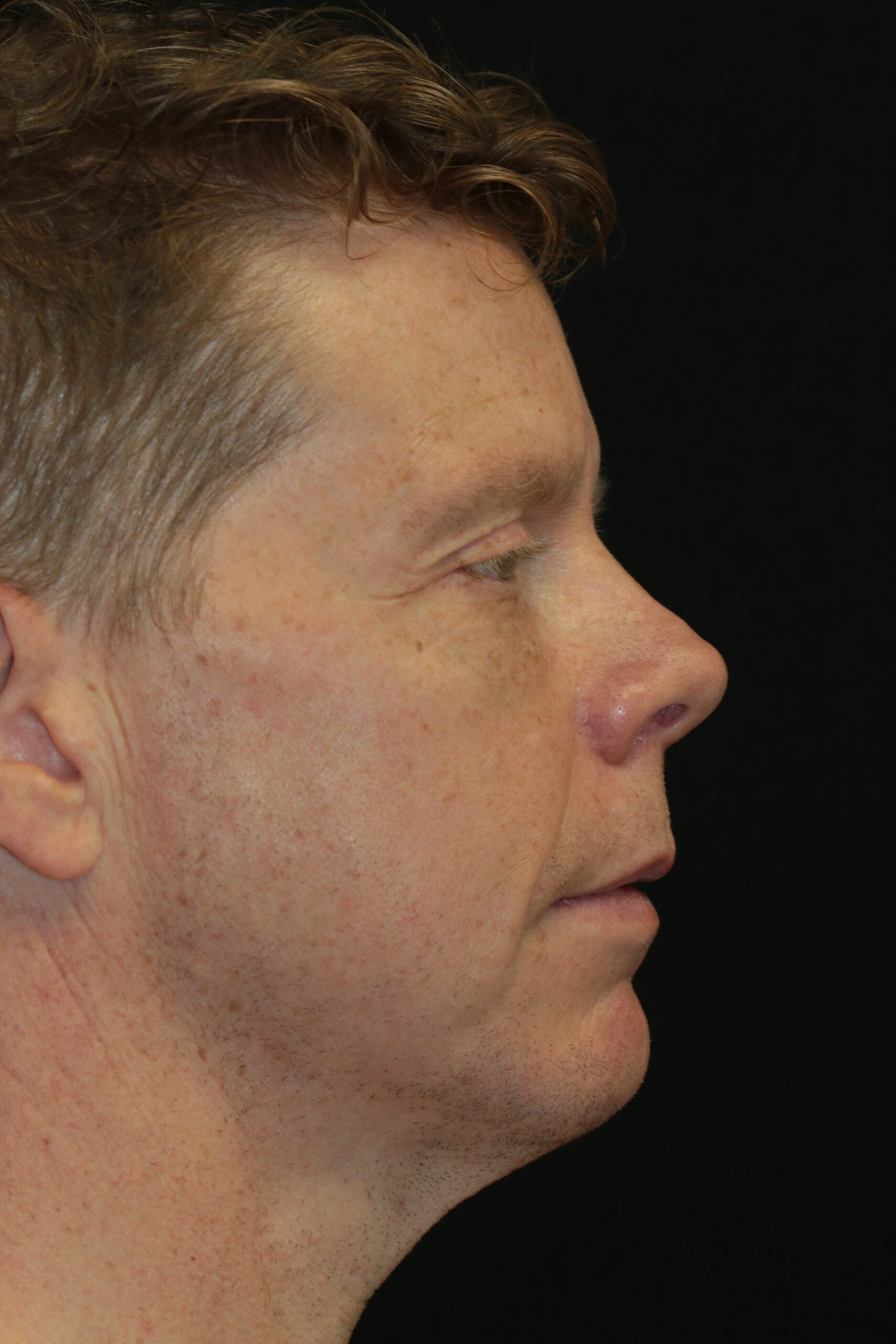 Face Lift - Before & After - Dr. Placik