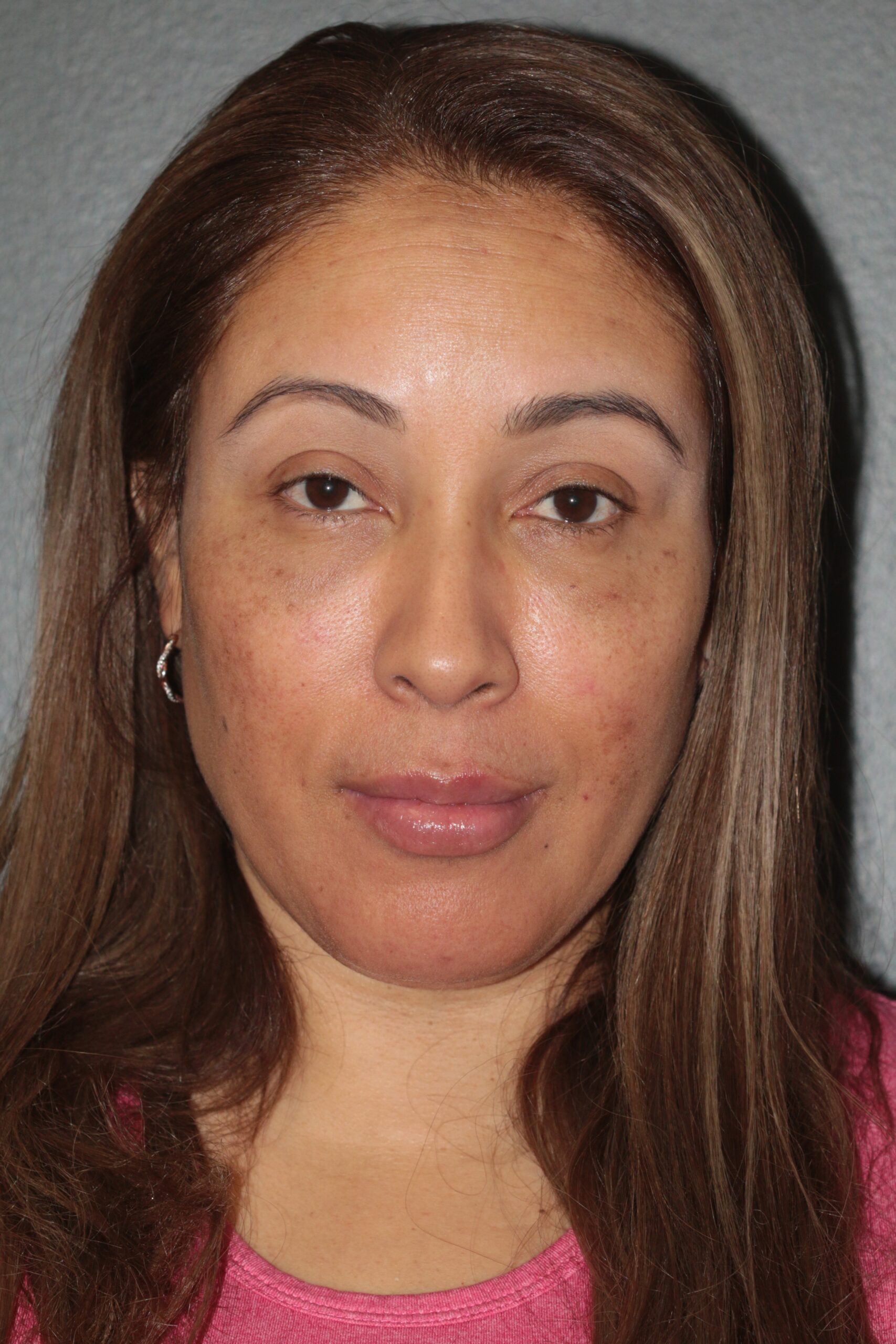 Lipoinjection to Various Facial Areas - Before & After - Dr. Placik
