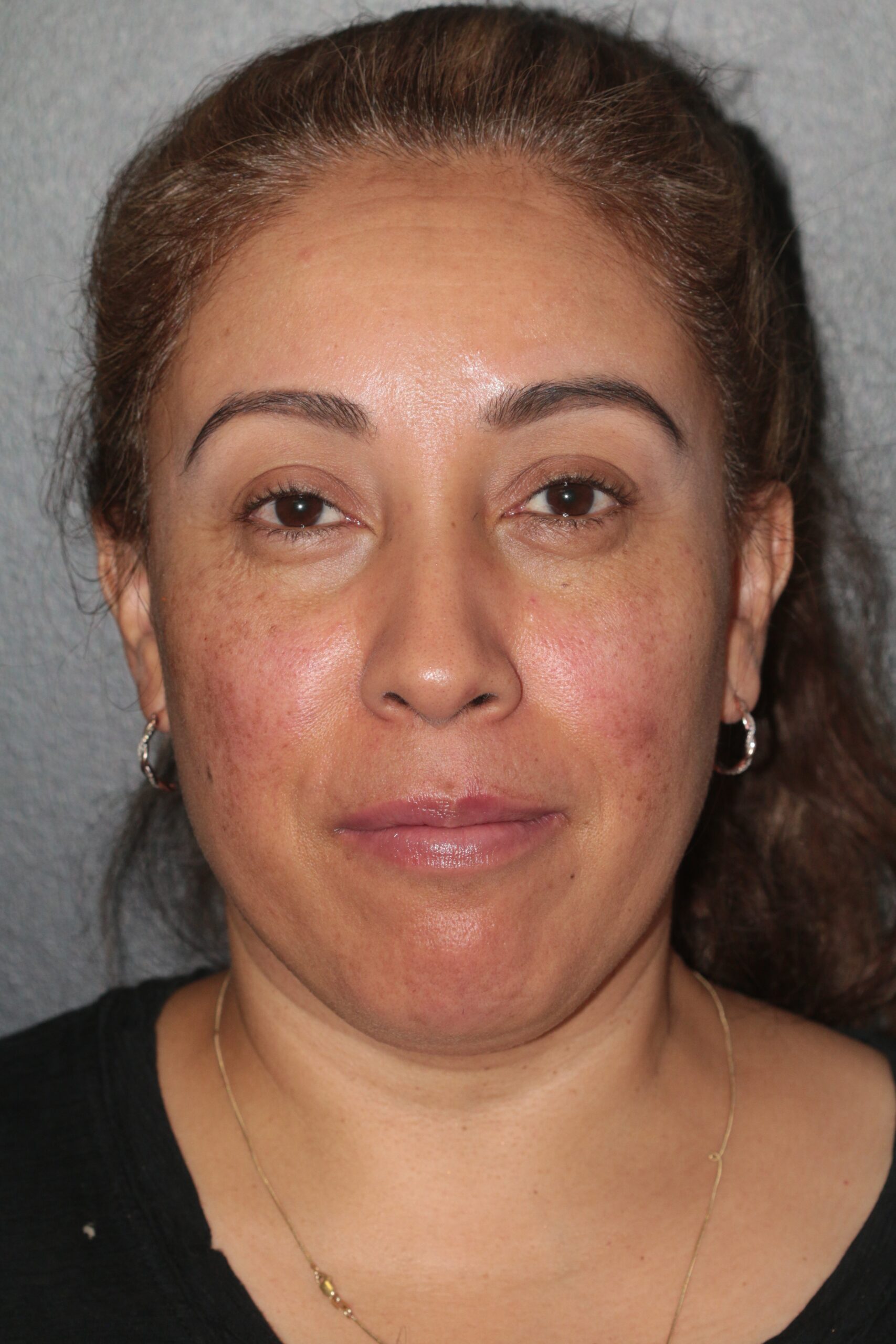Lipoinjection to Various Facial Areas - Before & After - Dr. Placik