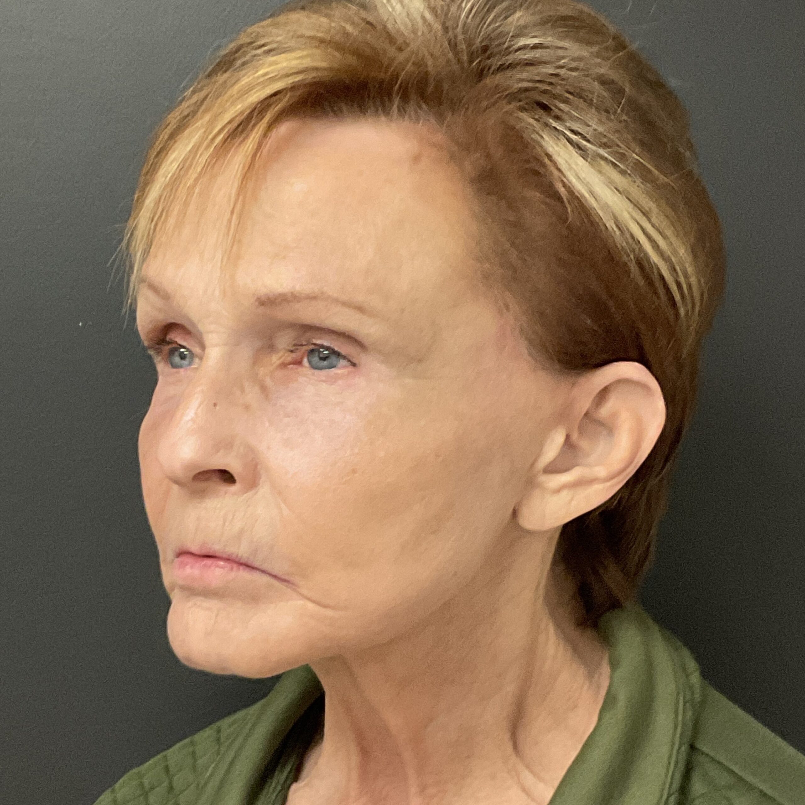 Face Lift - Before & After - Dr. Placik