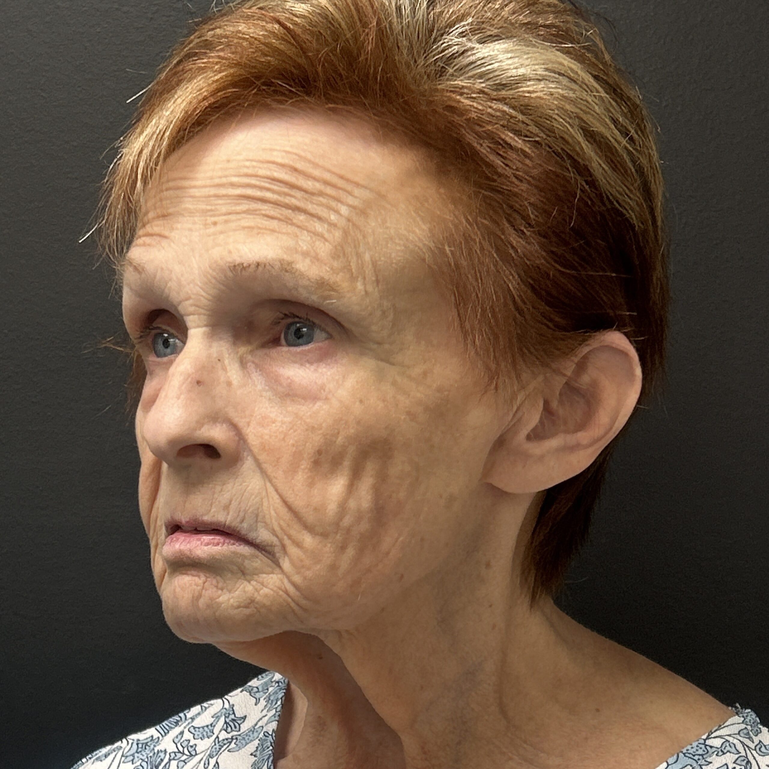 Face Lift - Before & After - Dr. Placik