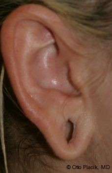 Earlobe Repair - Before & After - Dr. Placik