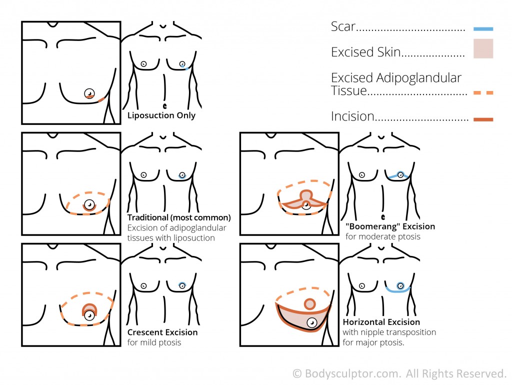 Breast Sculptor Effective 85