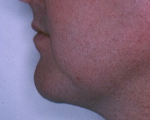 Chin Surgery - Before & After - Dr. Placik