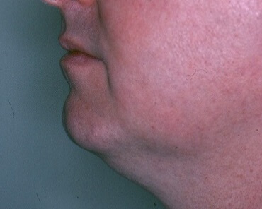 Chin Surgery - Before & After - Dr. Placik