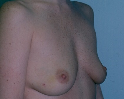 Before & After Breast Augmentation Gallery - Before & After - Dr. Placik