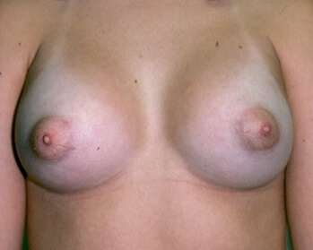 Before & After Breast Augmentation Gallery - Before & After - Dr. Placik