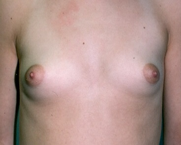 Before & After Breast Augmentation Gallery - Before & After - Dr. Placik