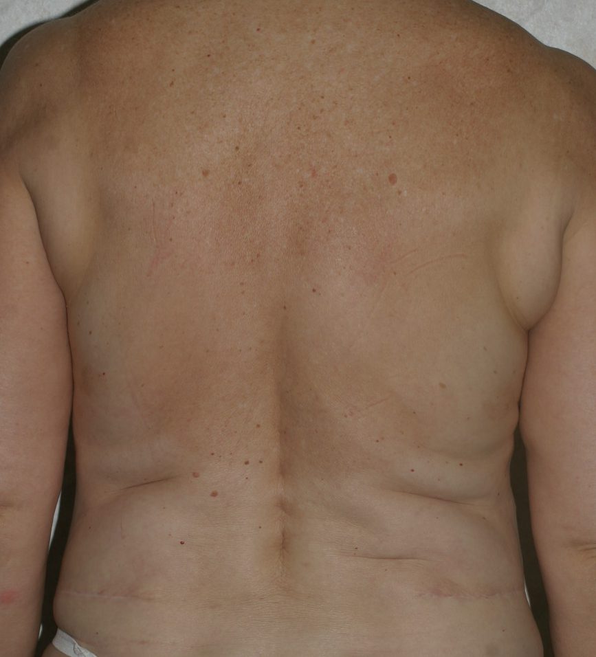 Body Lift - Before & After - Dr. Placik