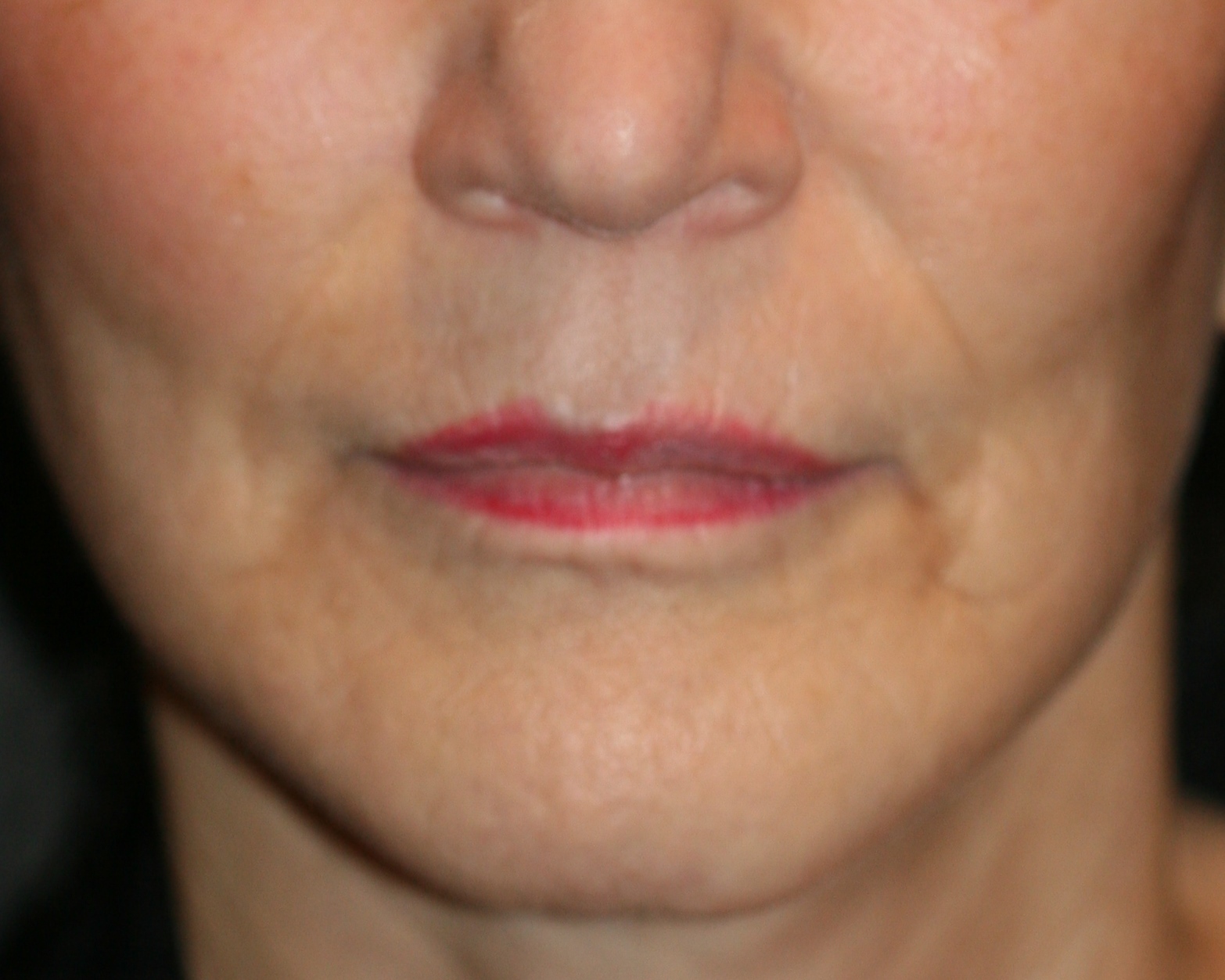 Lipoinjections to Various Facial Areas - Before & After - Dr. Placik