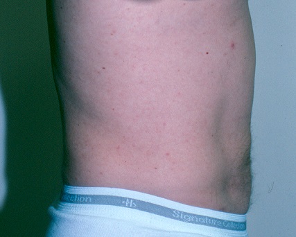 Male Liposuction - Before & After - Dr. Placik