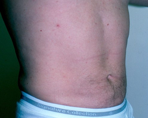 Male Liposuction Chicago