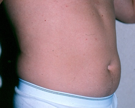 Male Liposuction Chicago