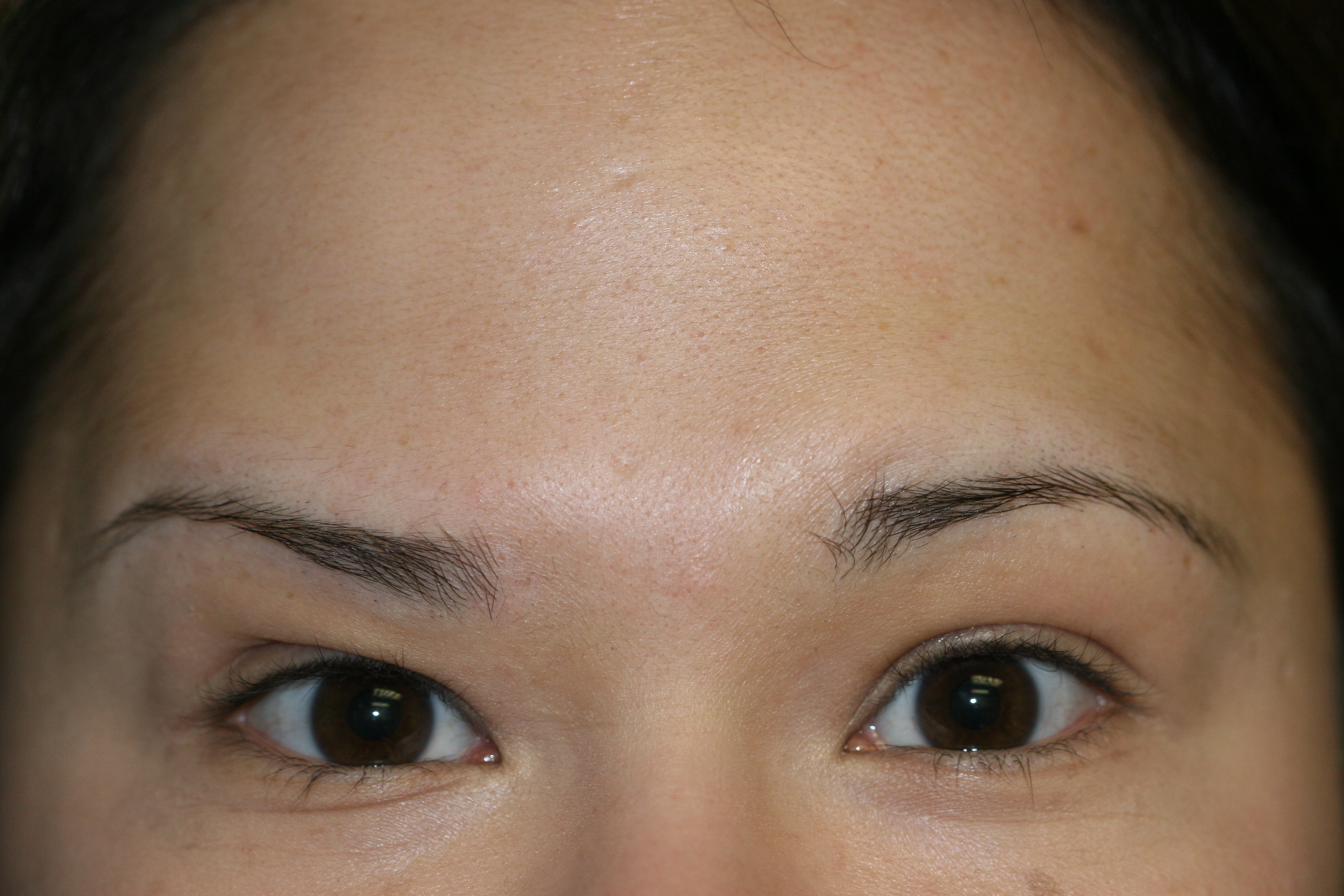 Injectable Filler - Before & After - Dr. Placik