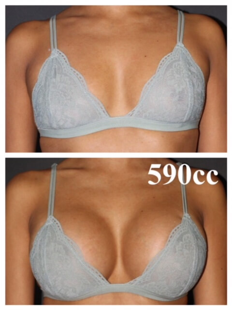 top rated breast augmentation surgeons