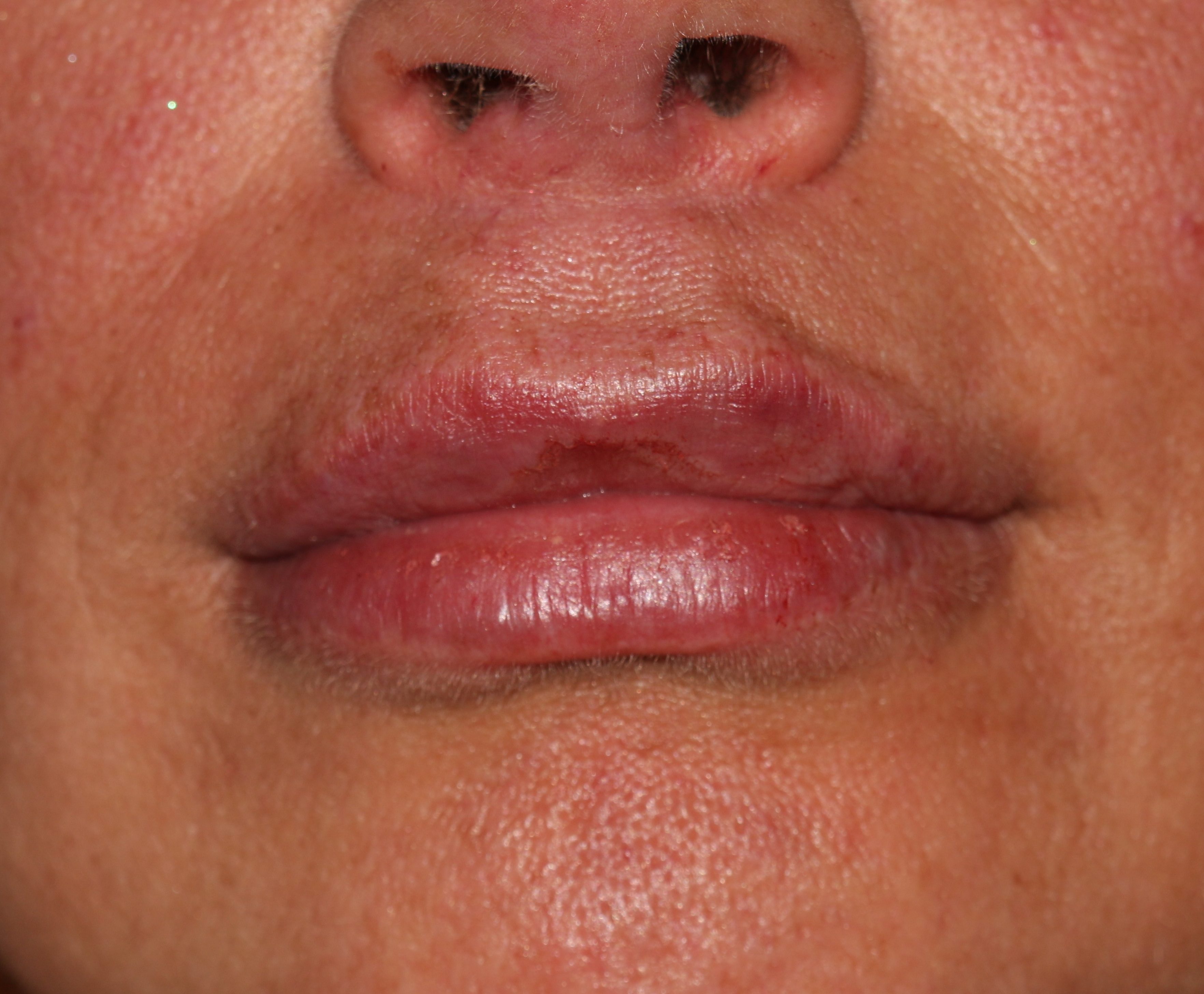 Lip Enhancement - Before & After - Dr. Placik