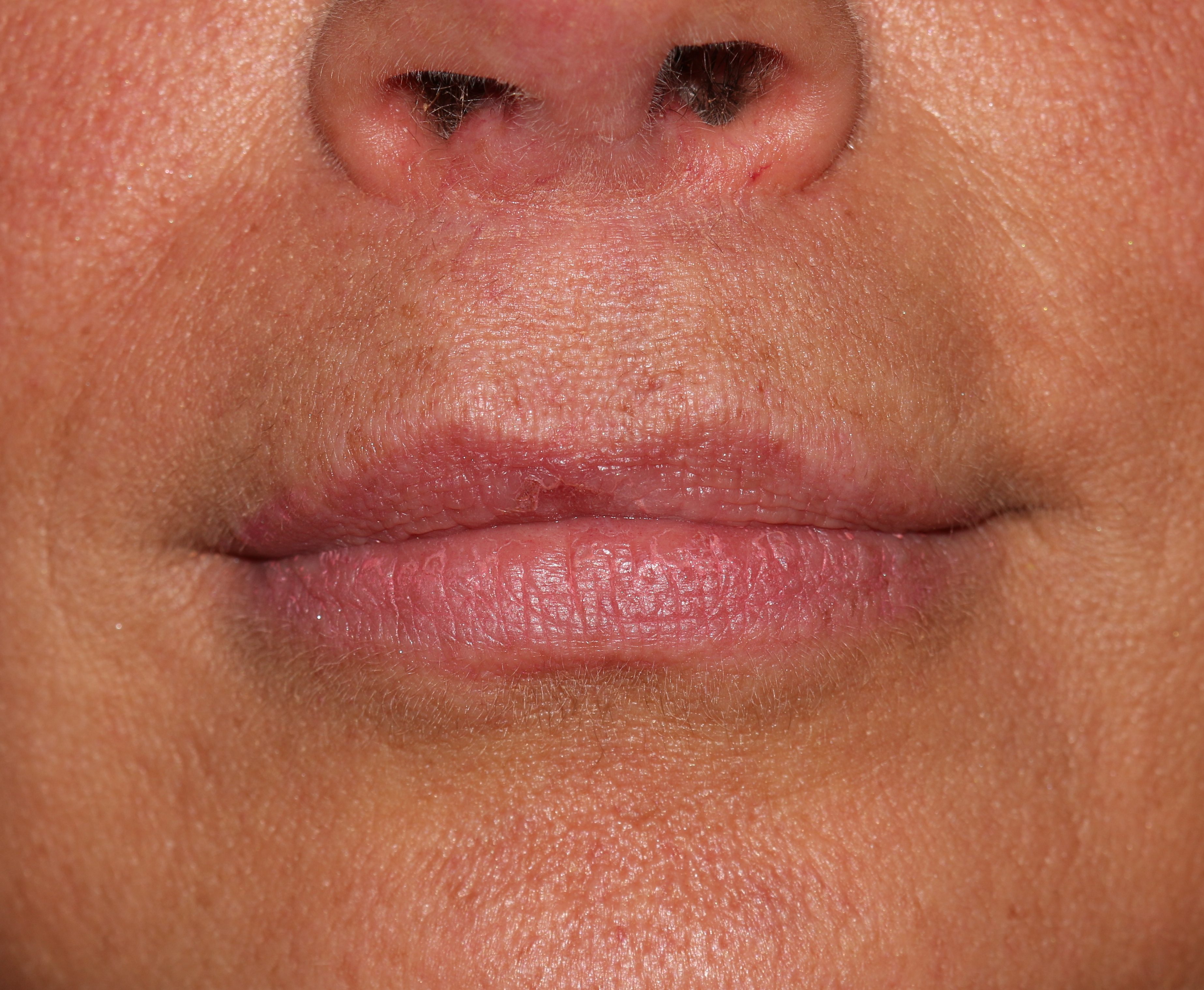 Lip Enhancement - Before & After - Dr. Placik