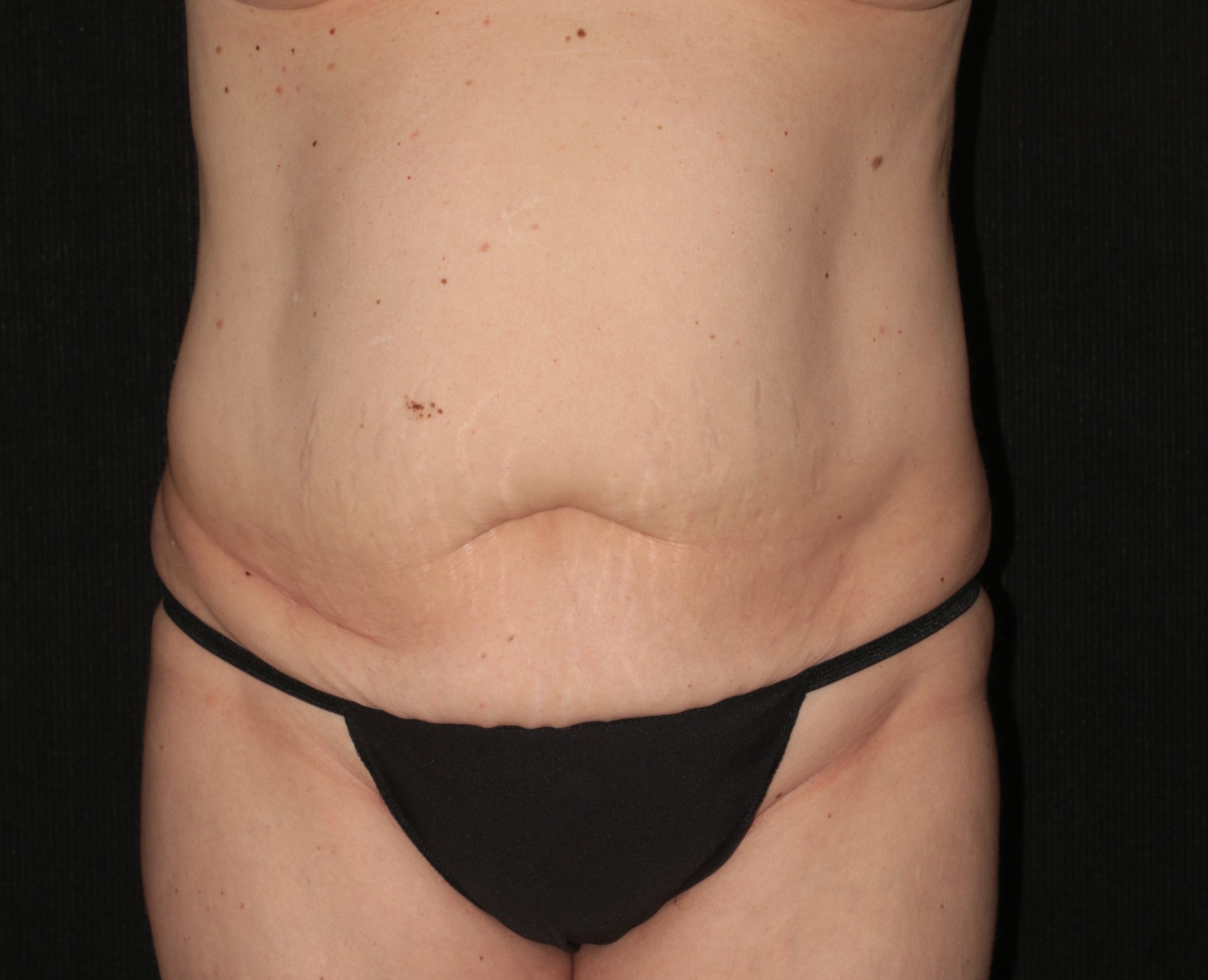 Tummy Tuck - Before & After - Dr. Placik